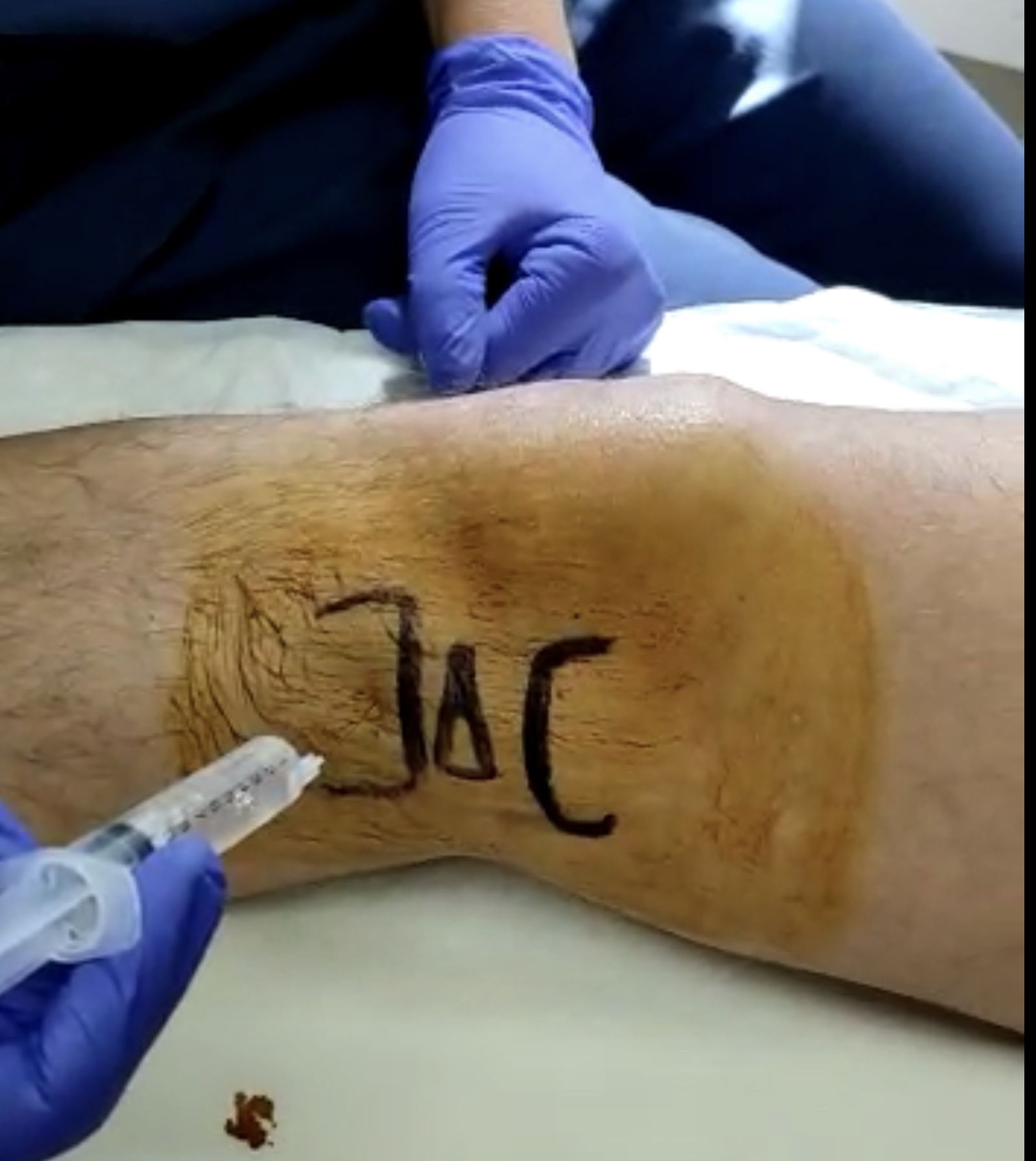 Infiltración en una rodilla.