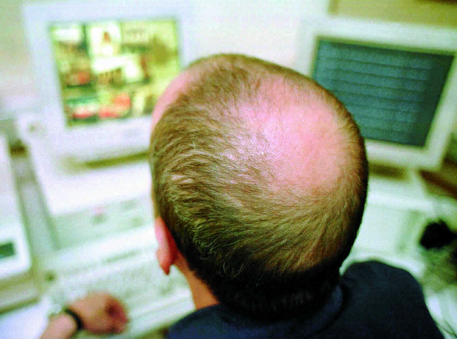 Un hombre con alopecia