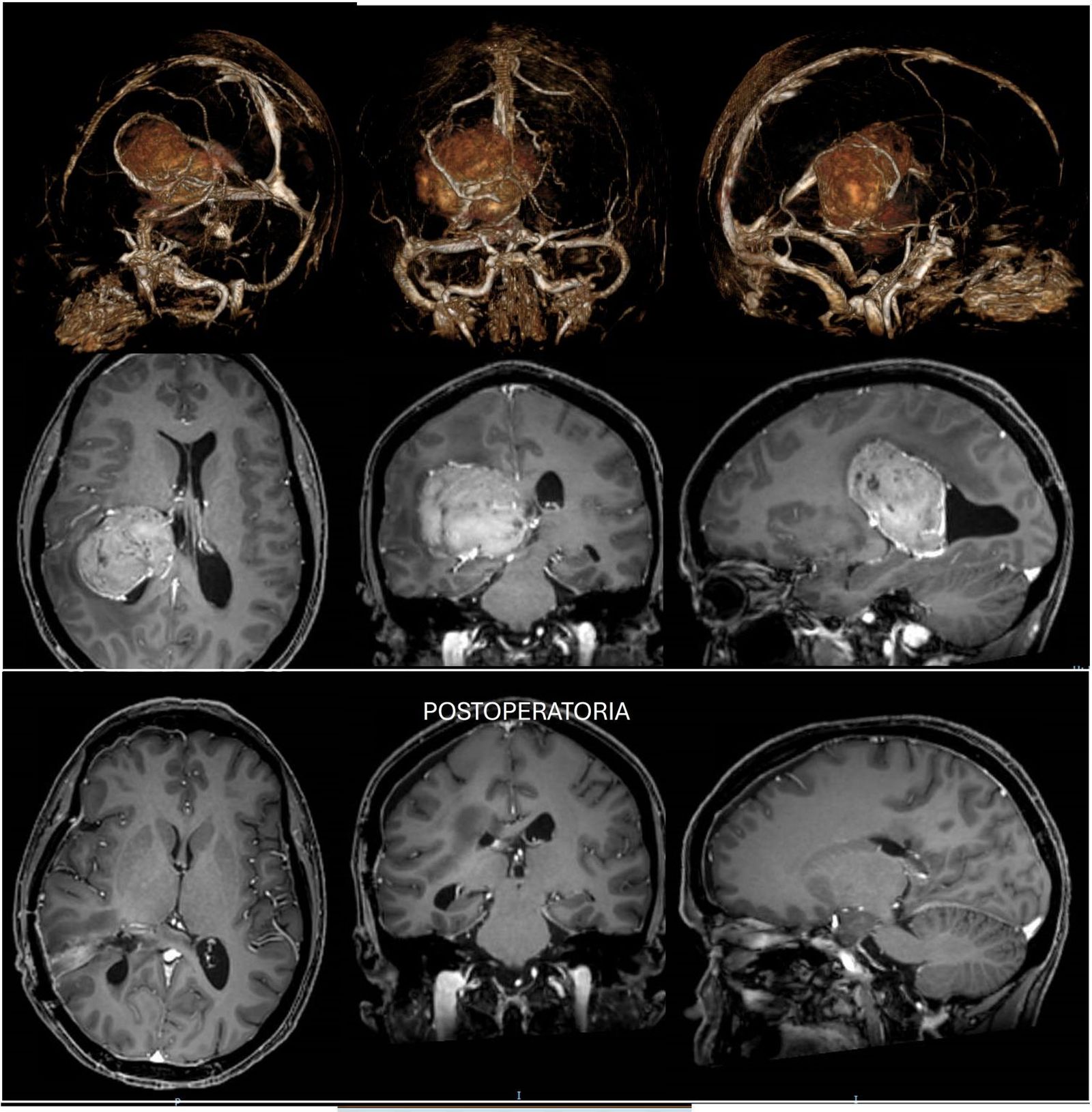 El Hospital Vithas de Granada extirpa con éxito un tumor cerebral de seis centímetros