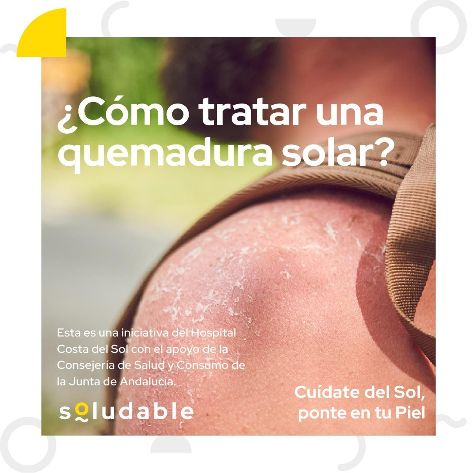 Guía con recomendaciones para tratar una quemadura de sol
