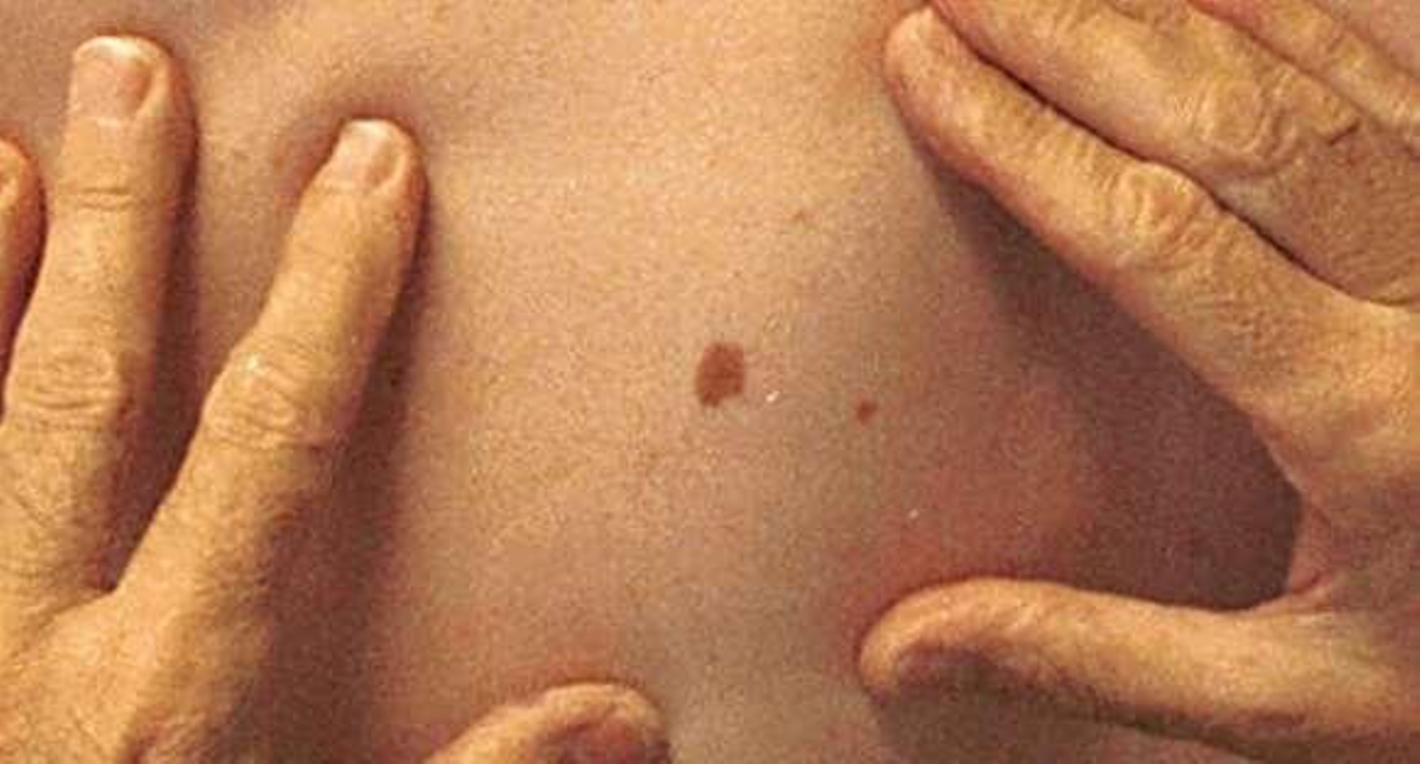 Una de cada 15 personas que revisa sus lunares padece algún tipo de melanoma