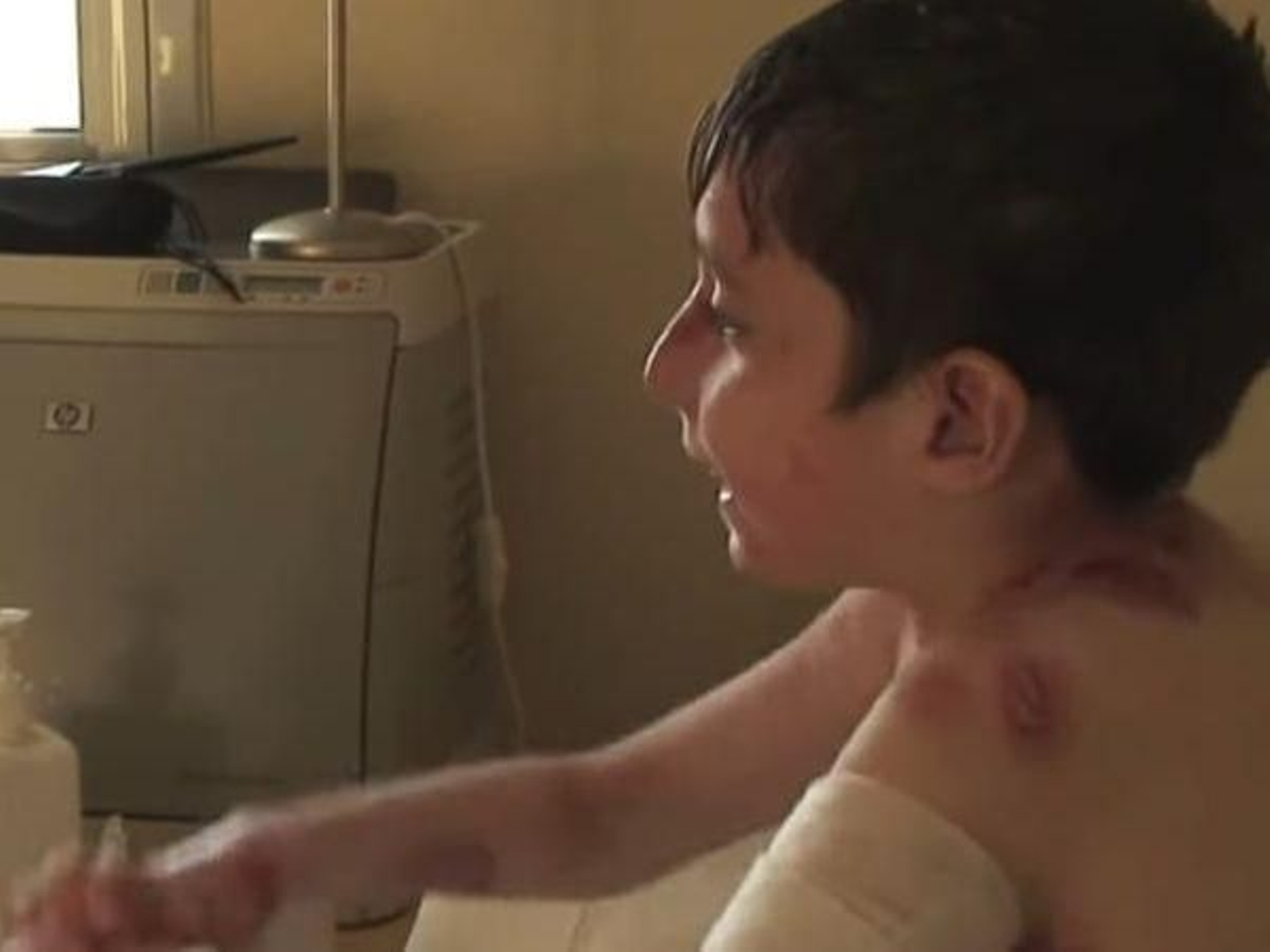 Niño con piel de mariposa recibiendo curas de sus heridas