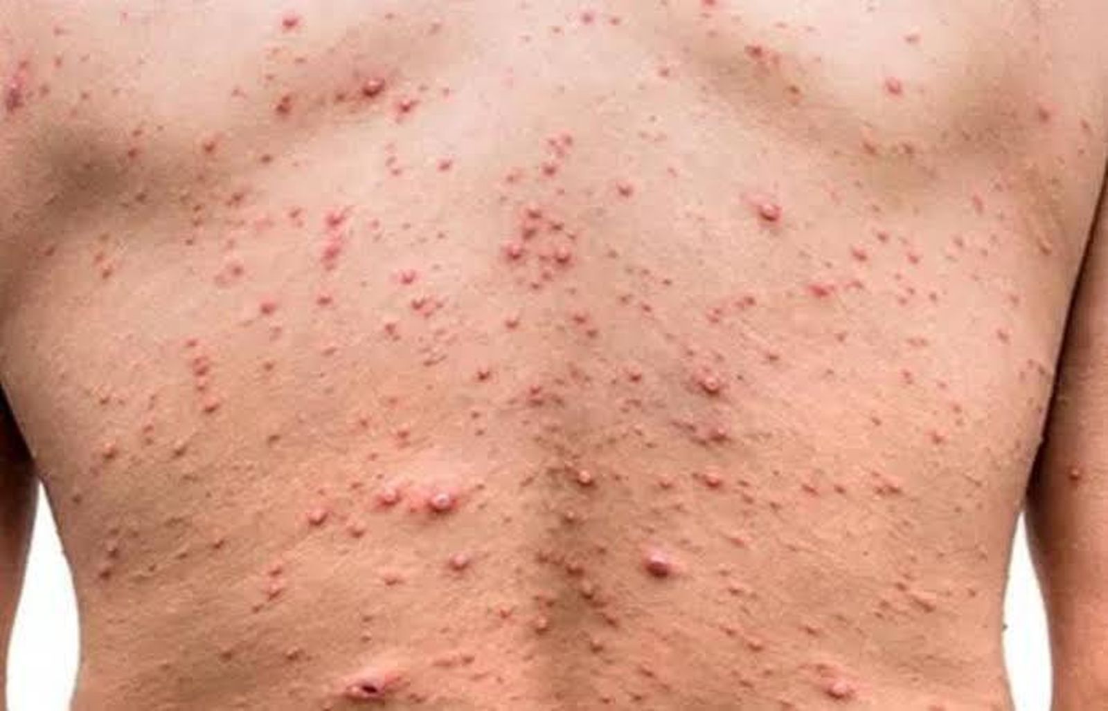 Un afectado por viruela del mono