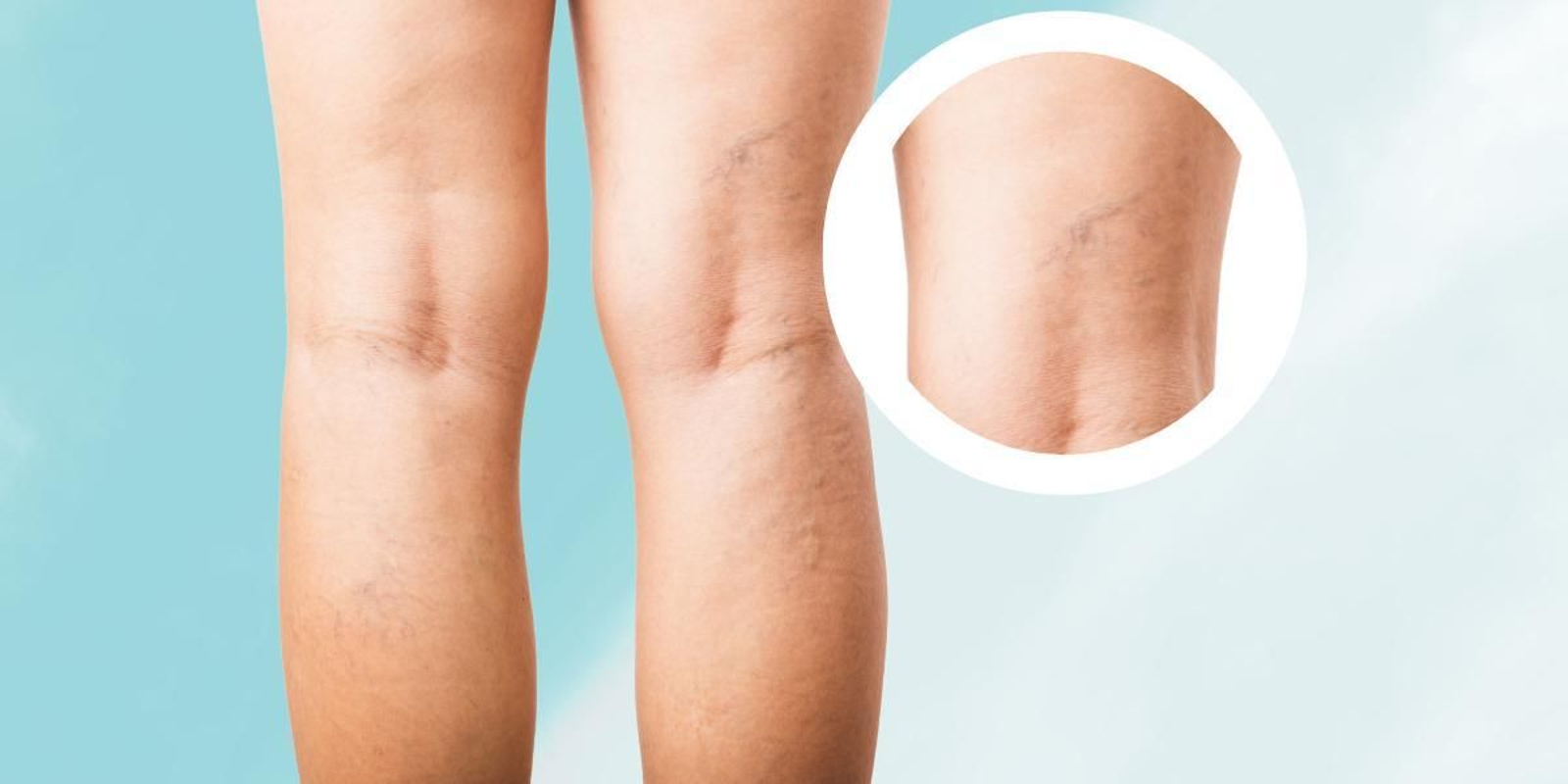 Cinco métodos eficaces contra las varices y arañas vasculares