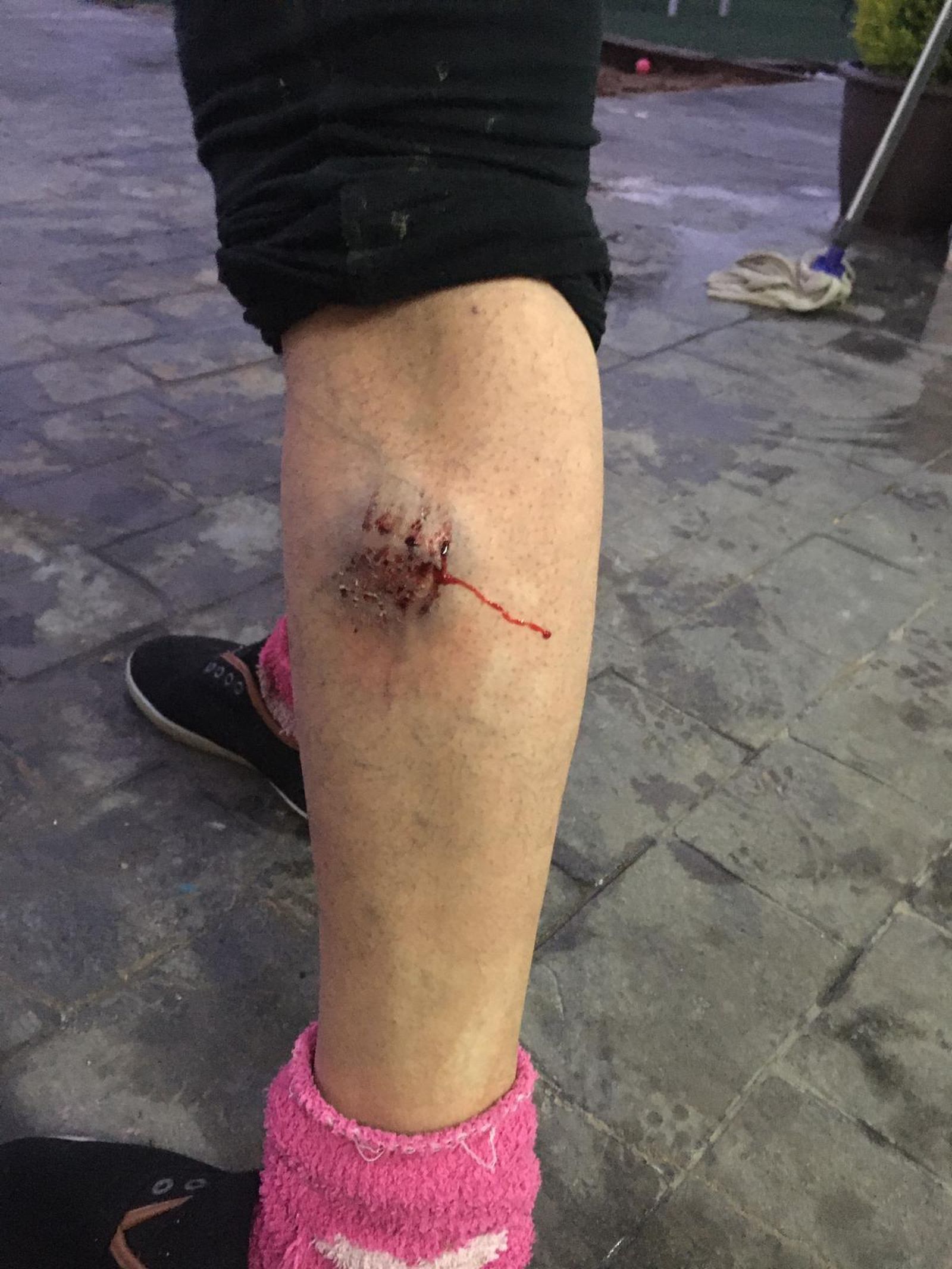 Heridas sufridas por la mujer en la otra pierna.