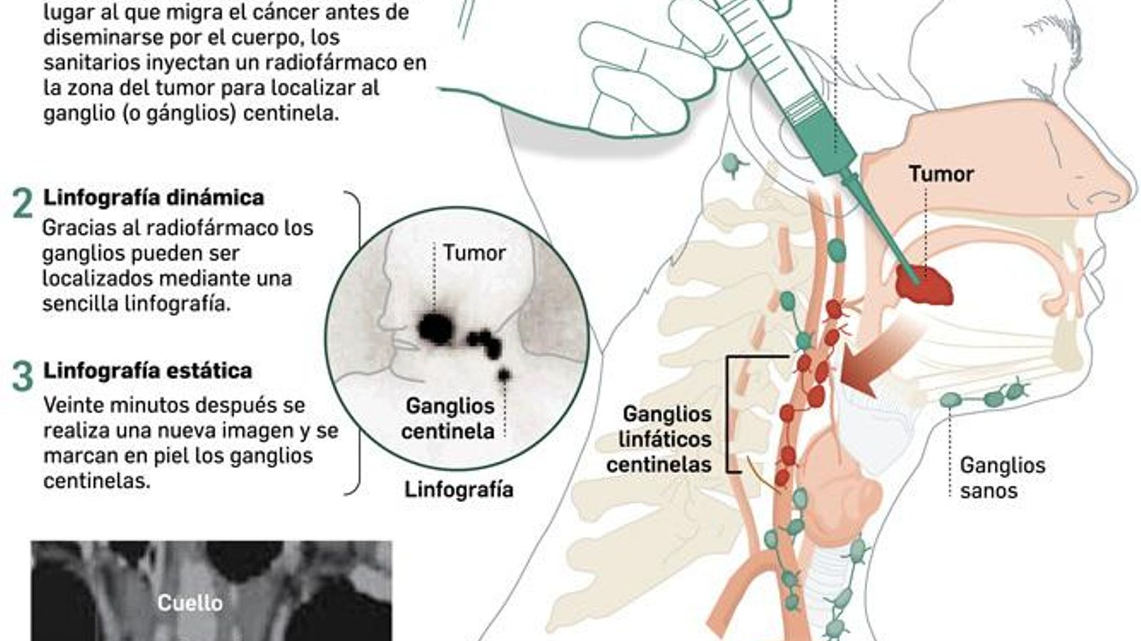 Biopsia selectiva del ganglio centinela en el cáncer oral. Fuente: Hospital Macarena.
