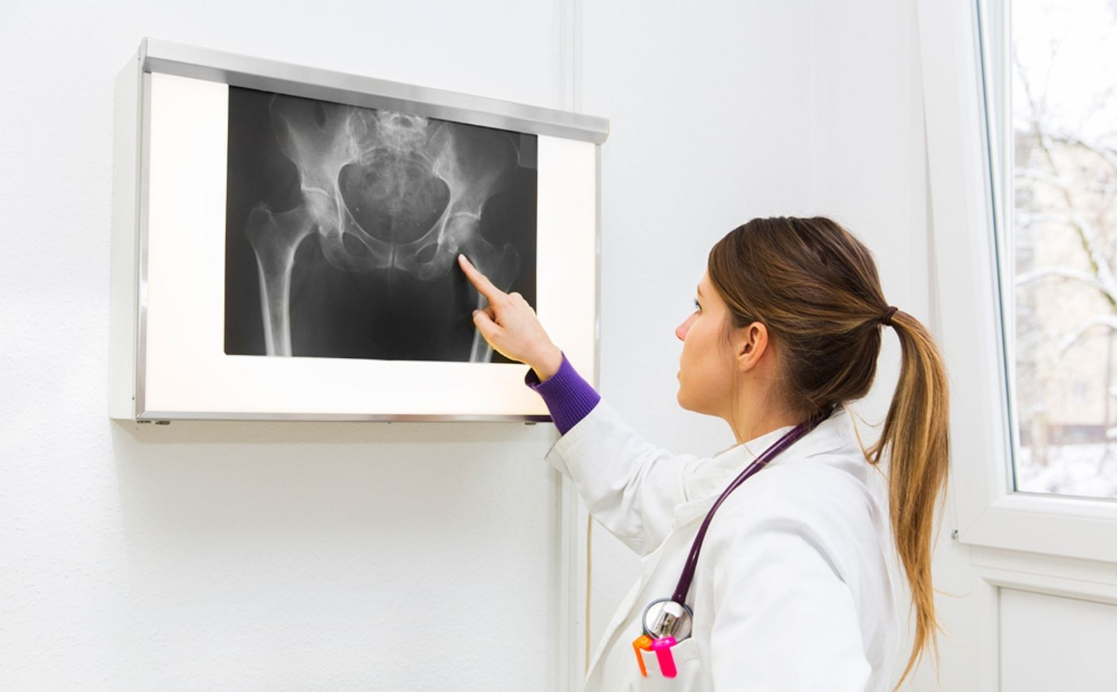 El tratamiento con ácido alendrónico reduce el riesgo de fracturas en la cadera debidas a la osteoporosis