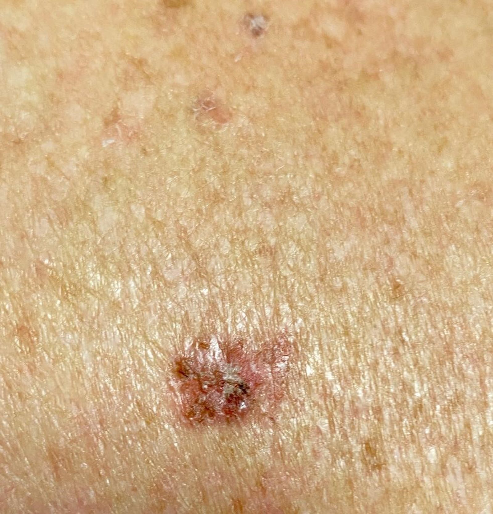 QUERATOSIS ACTÍNICA