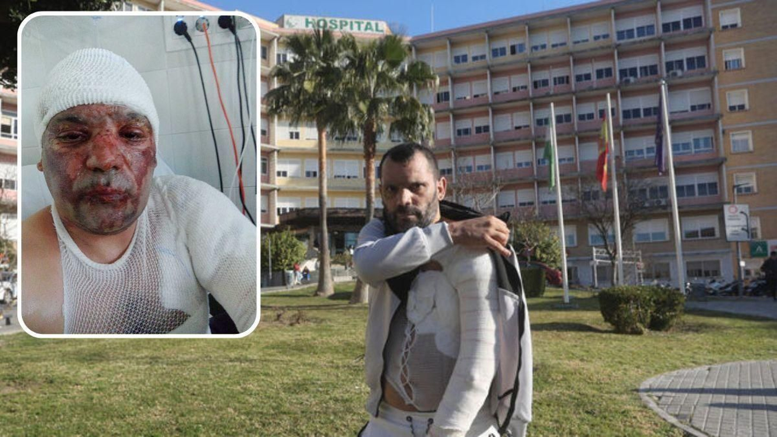 Francisco Javier Crespo López, al salir del hospital y con las quemaduras en tratamiento.