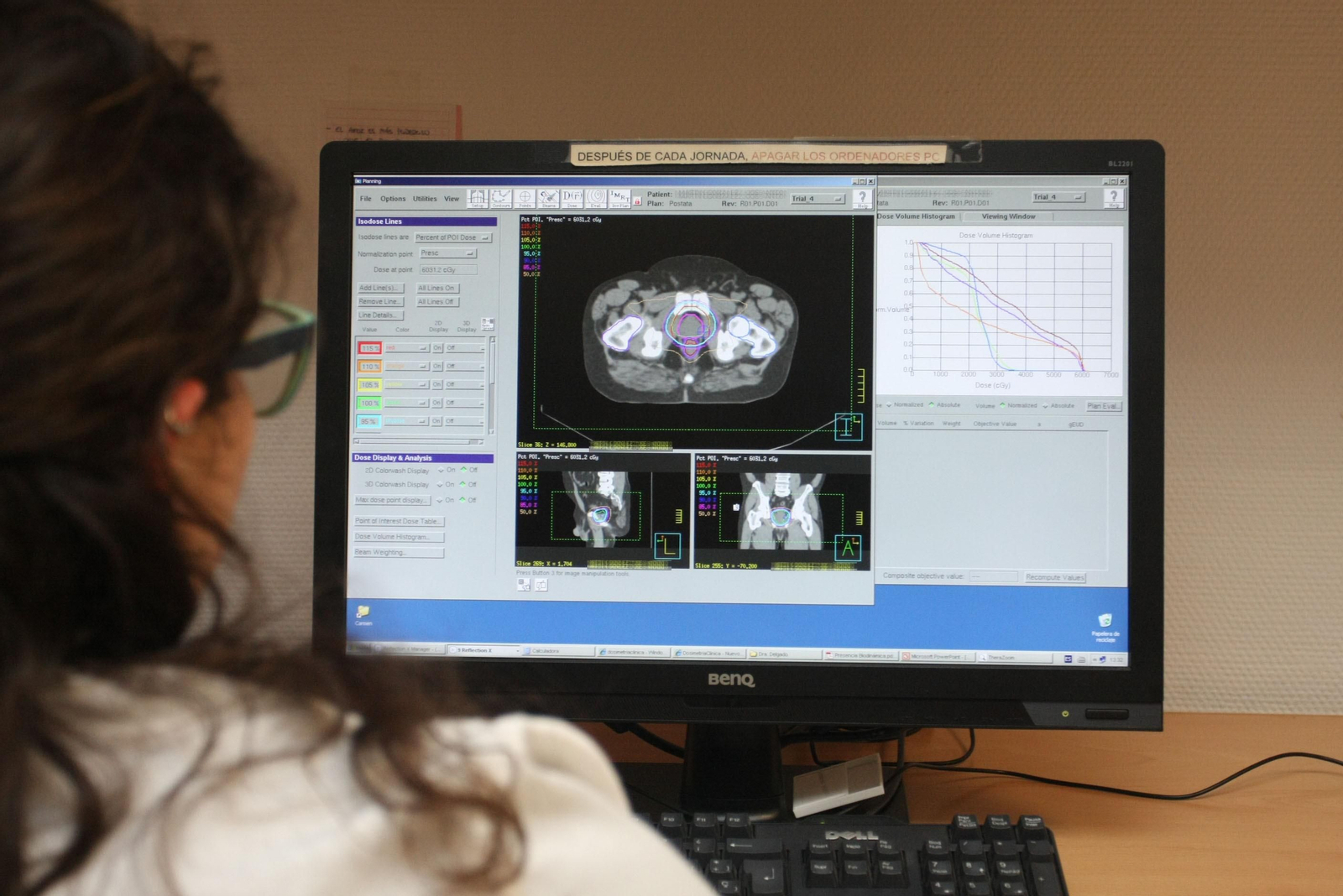 Una especialista observa una prueba de un paciente con cáncer de próstata.