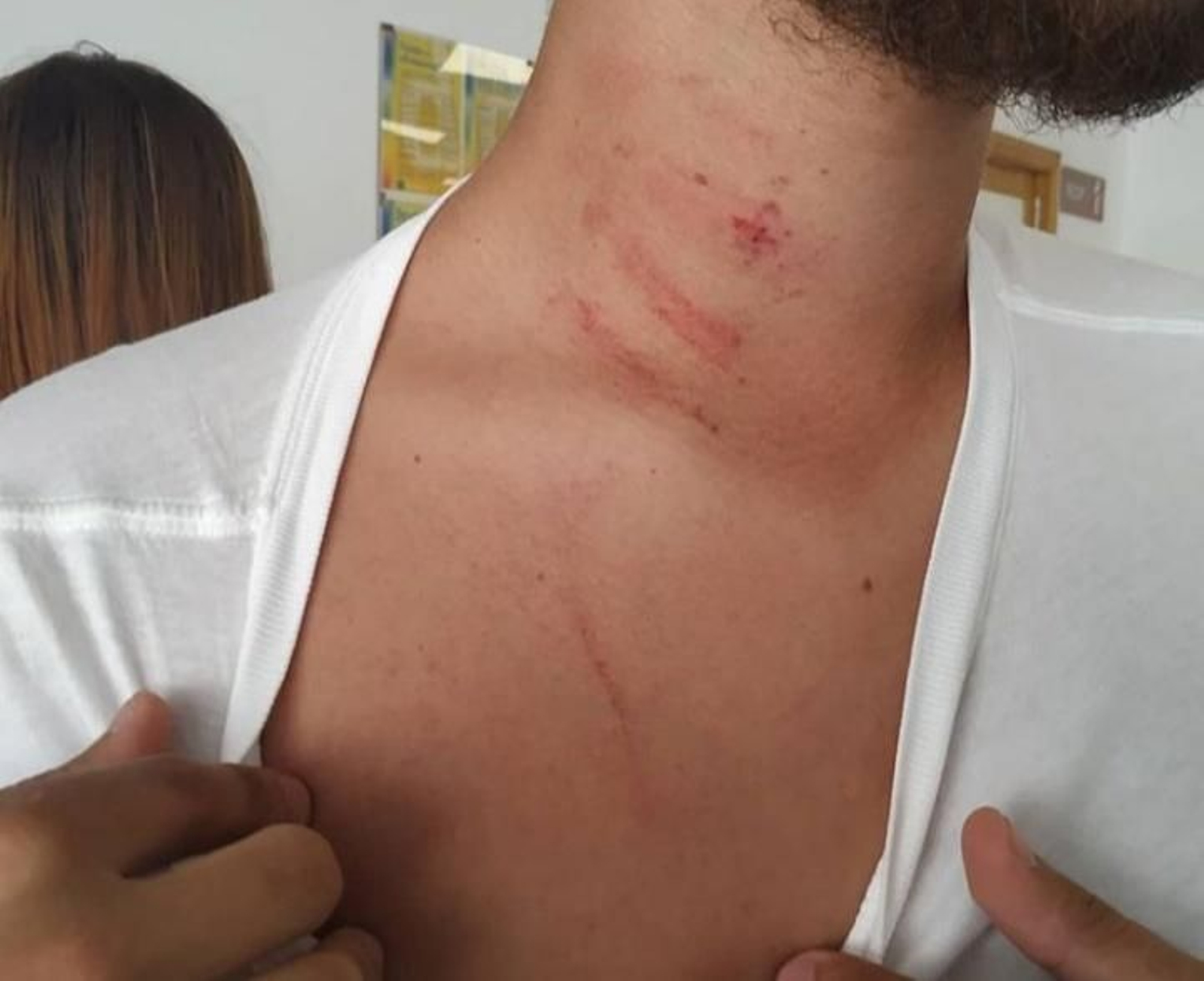Imagen del cuello del árbitro tomada en el hospital tras la agresión. Imagen del cuello del árbitro tomada en el hospital tras la agresión.