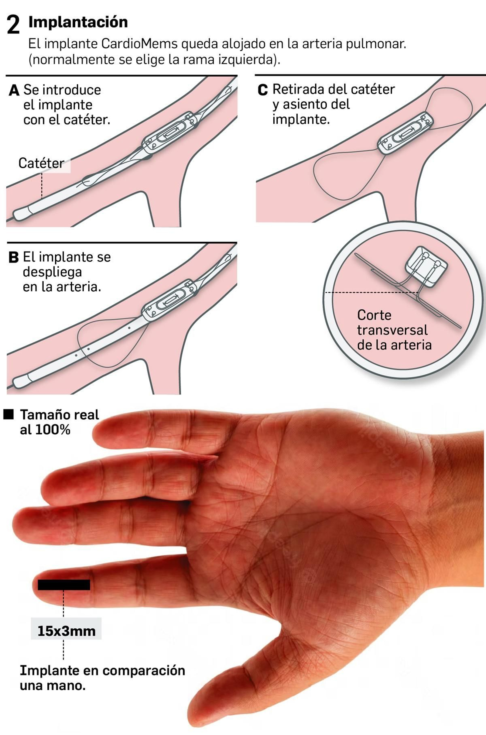 Detalle de la implantación.