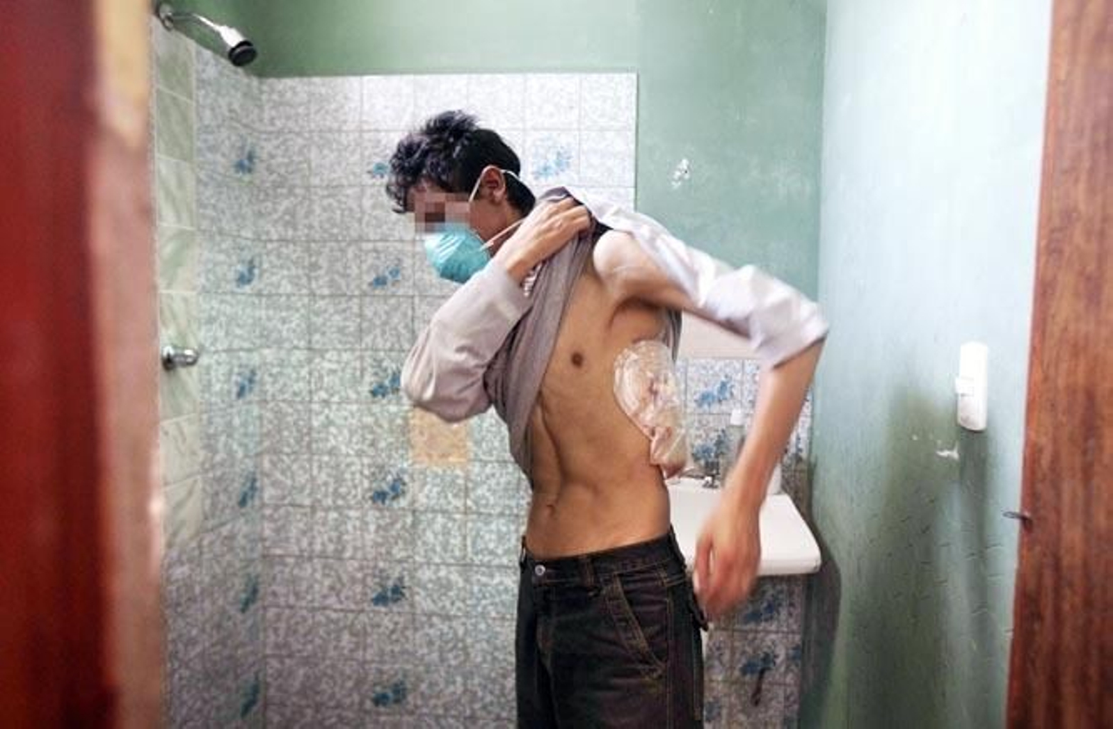 Un hombre con tuberculosis se somete a una revisión.