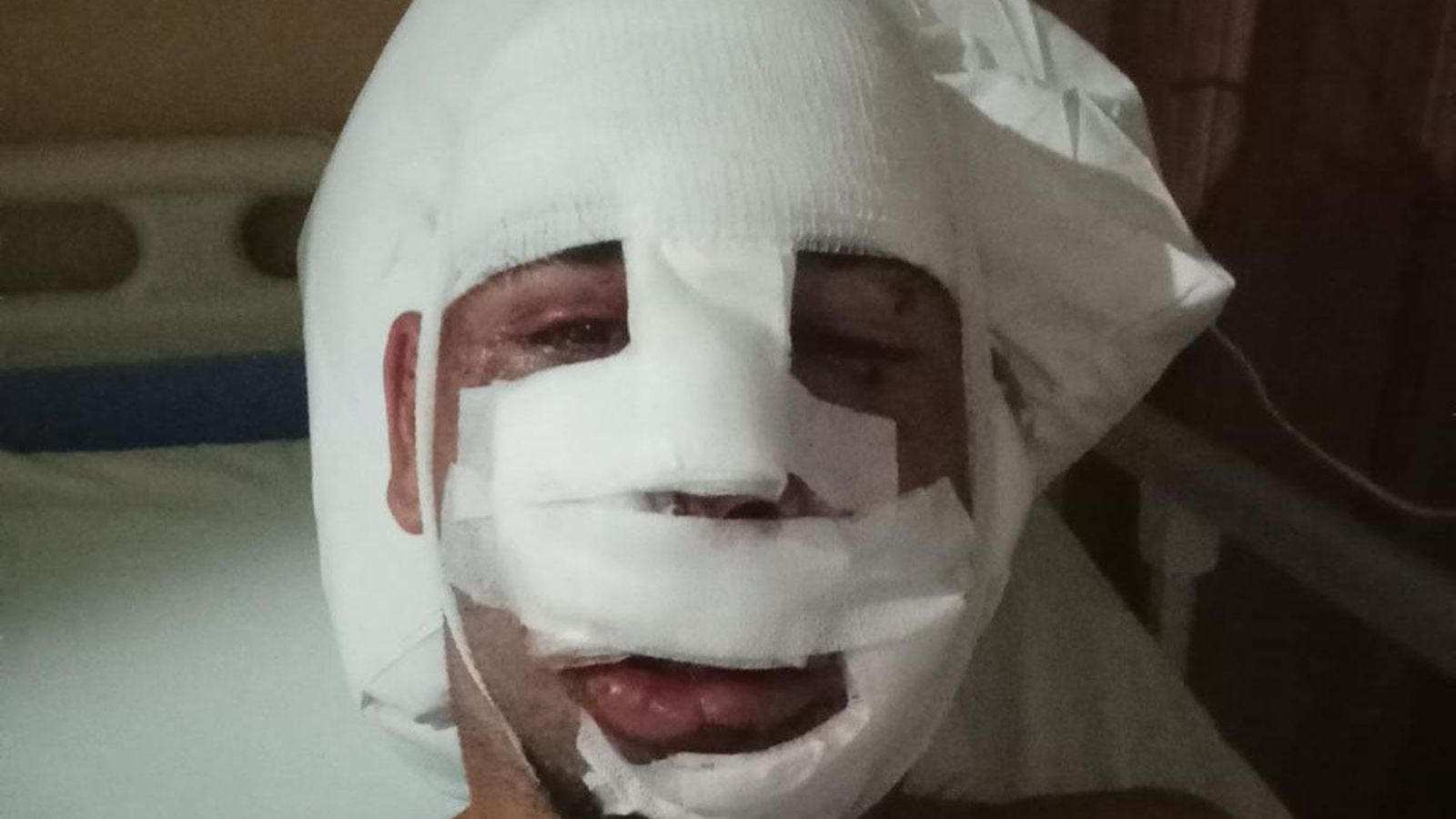 Jaime con la cara vendada tras las operaciones