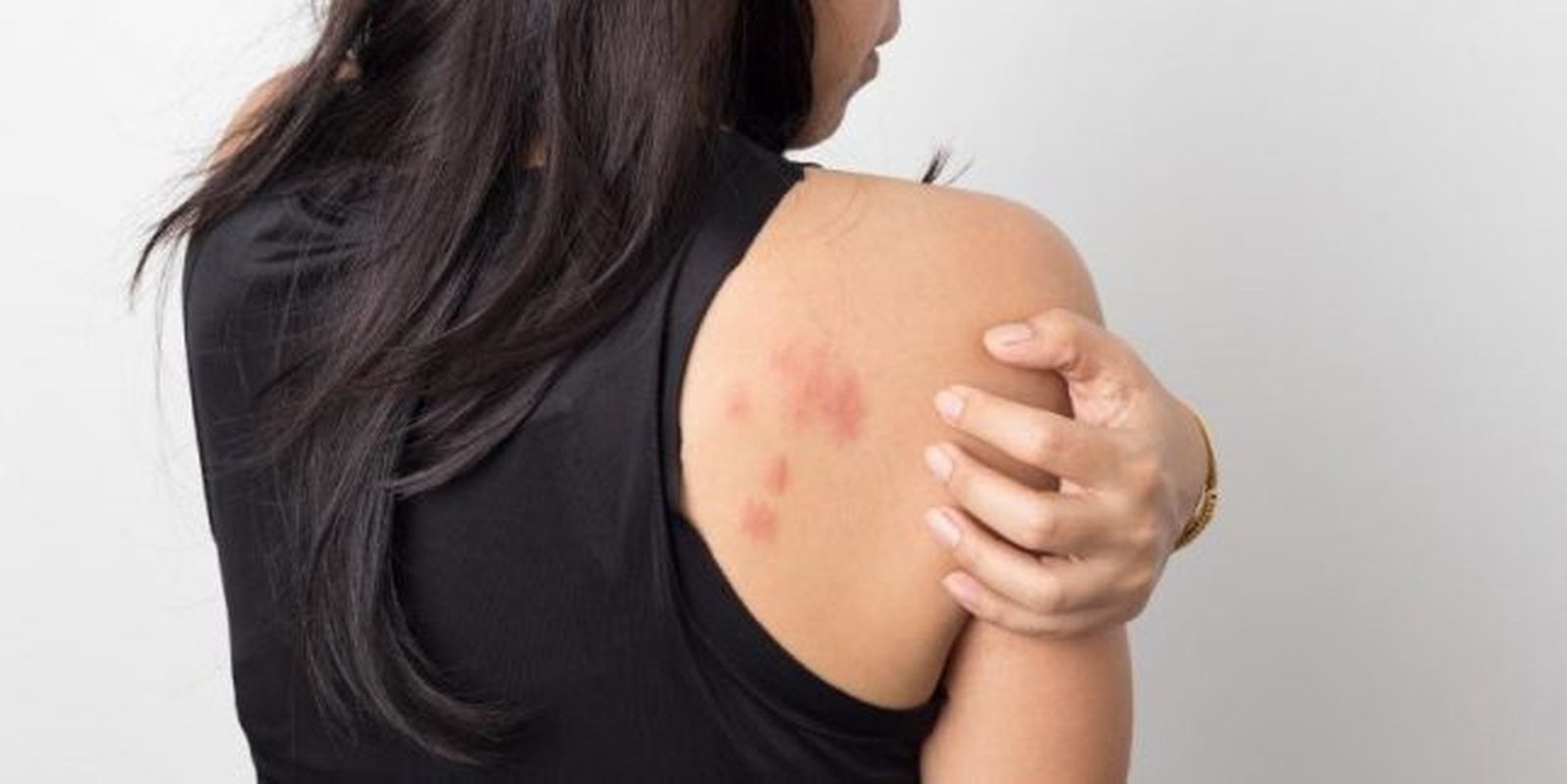 Un estudio concluye que las lesiones en la piel pueden ser el primer síntoma para detectar los casos de coronavirus