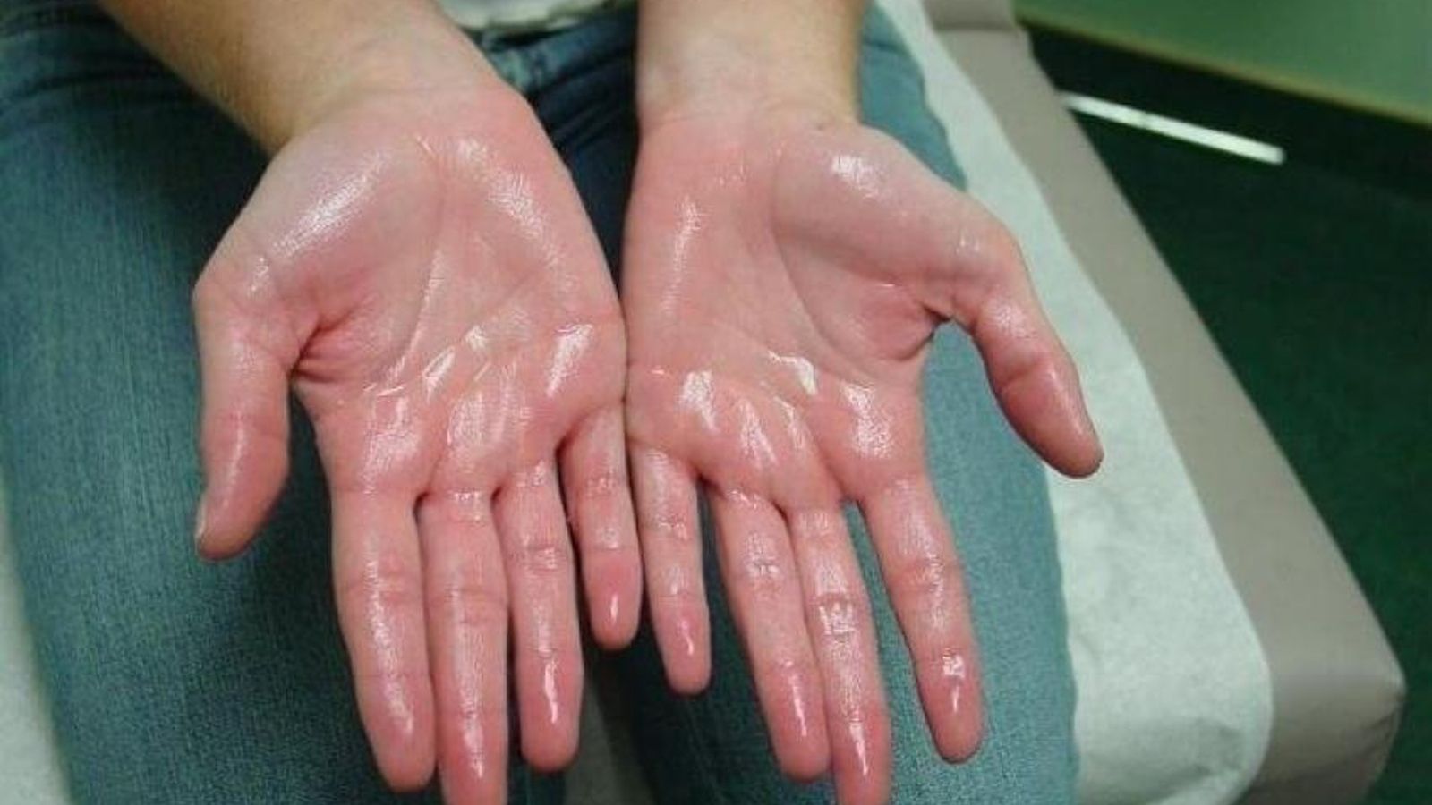 La hiperhidrosis puede provocar infecciones.