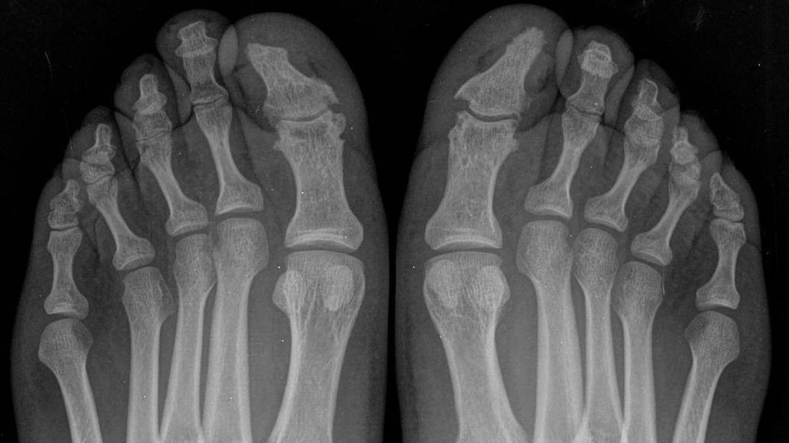 Afectación osteo-articular de la enfermedad en ambos pies.