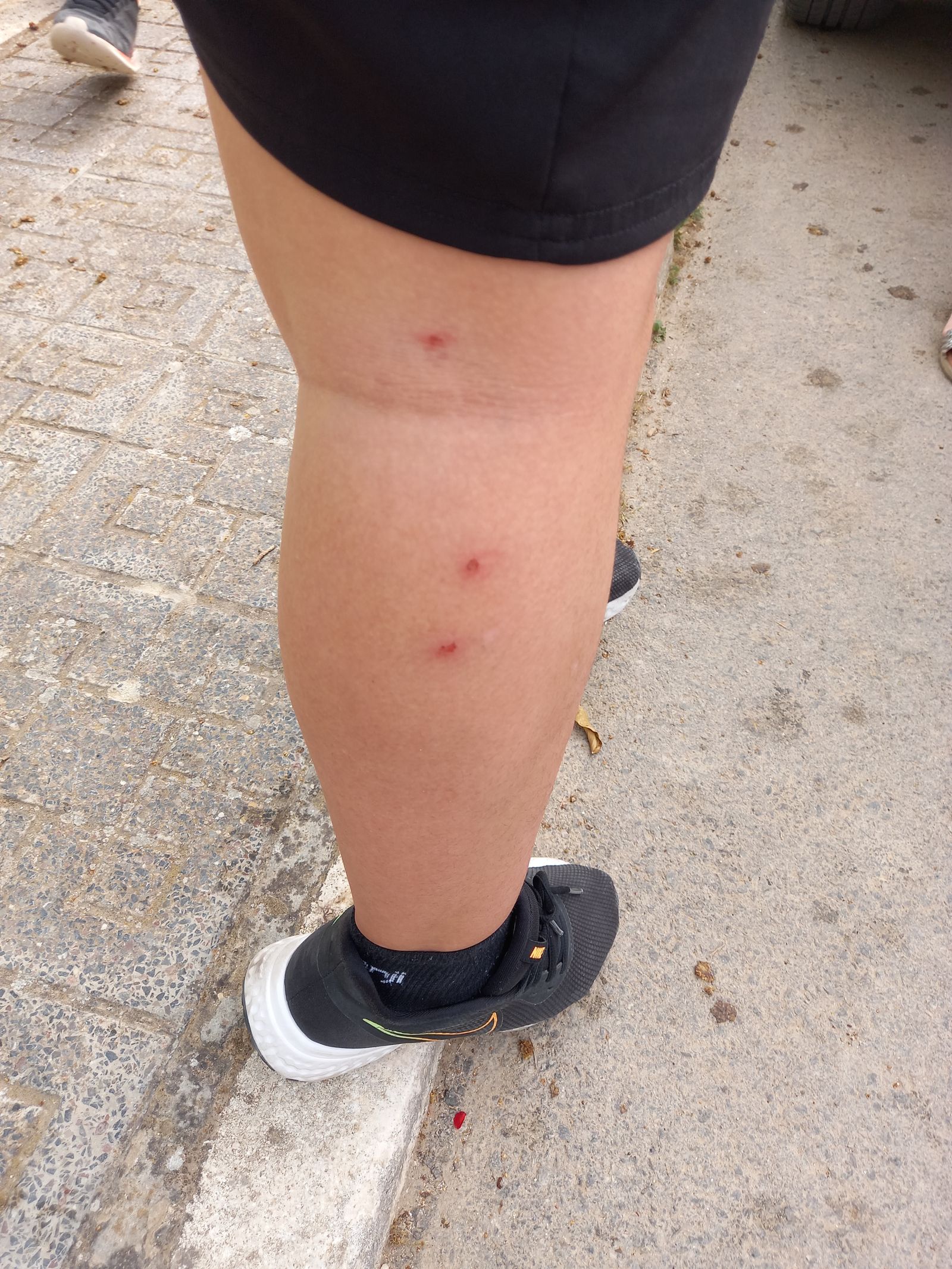 Un vecino muestra picaduras de mosquito en la pierna.