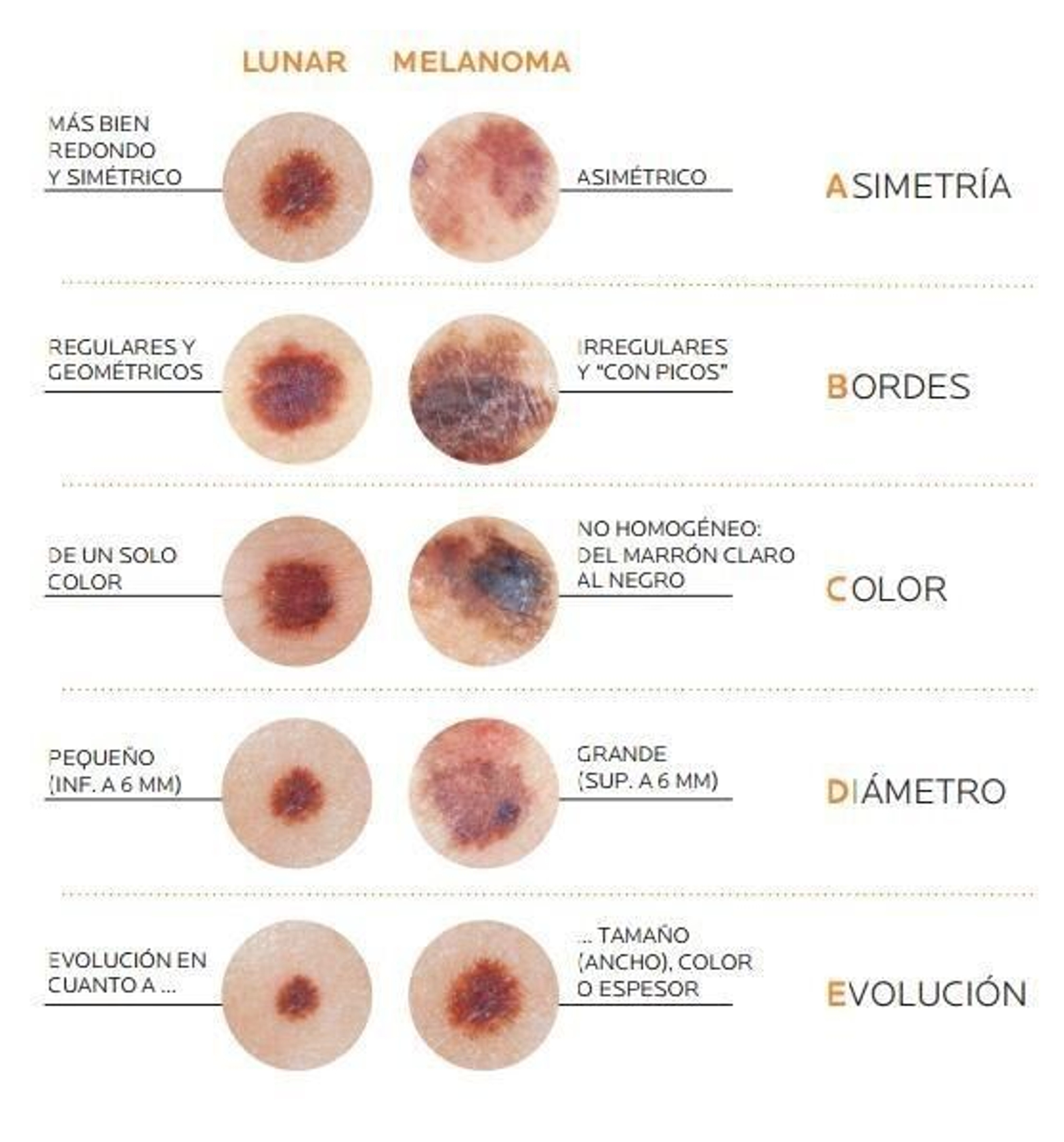 Melanoma tipos