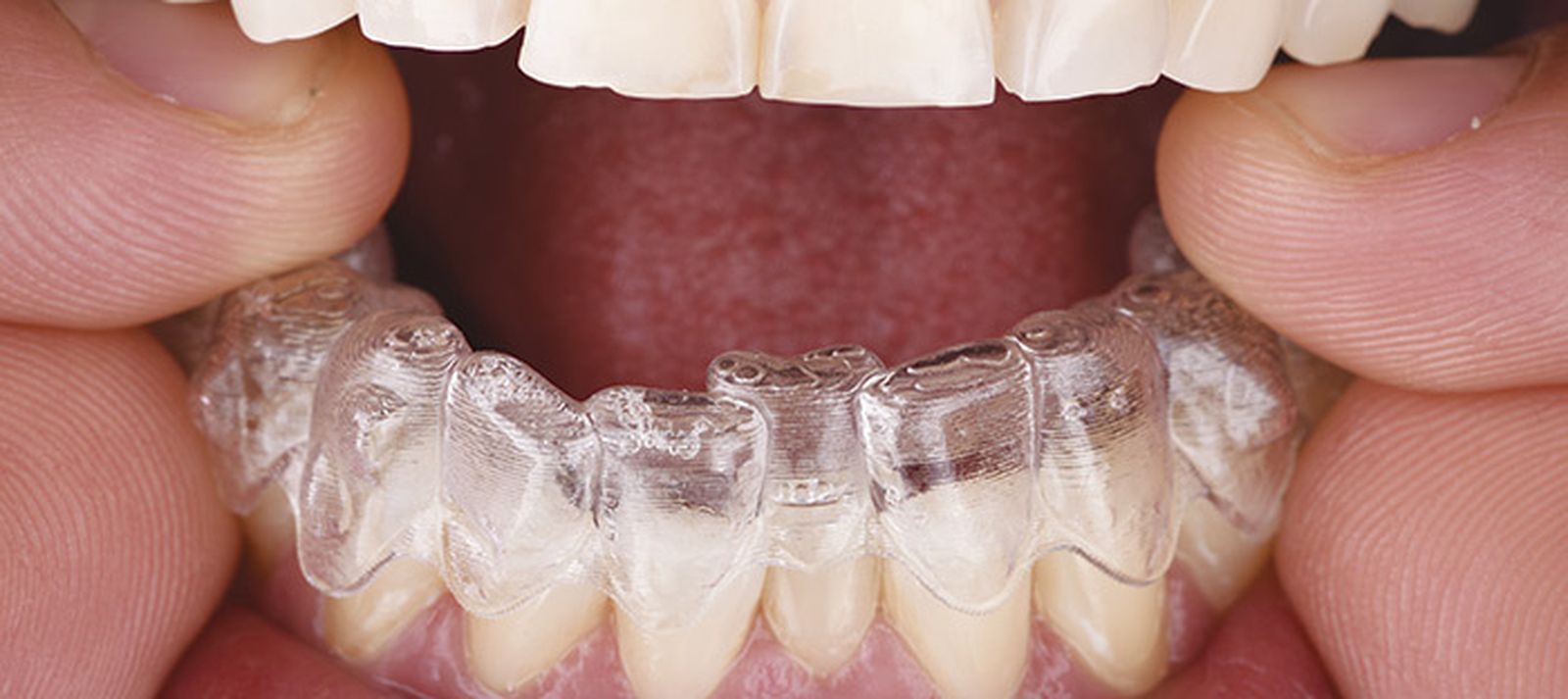 Una persona con ortodoncia invisible