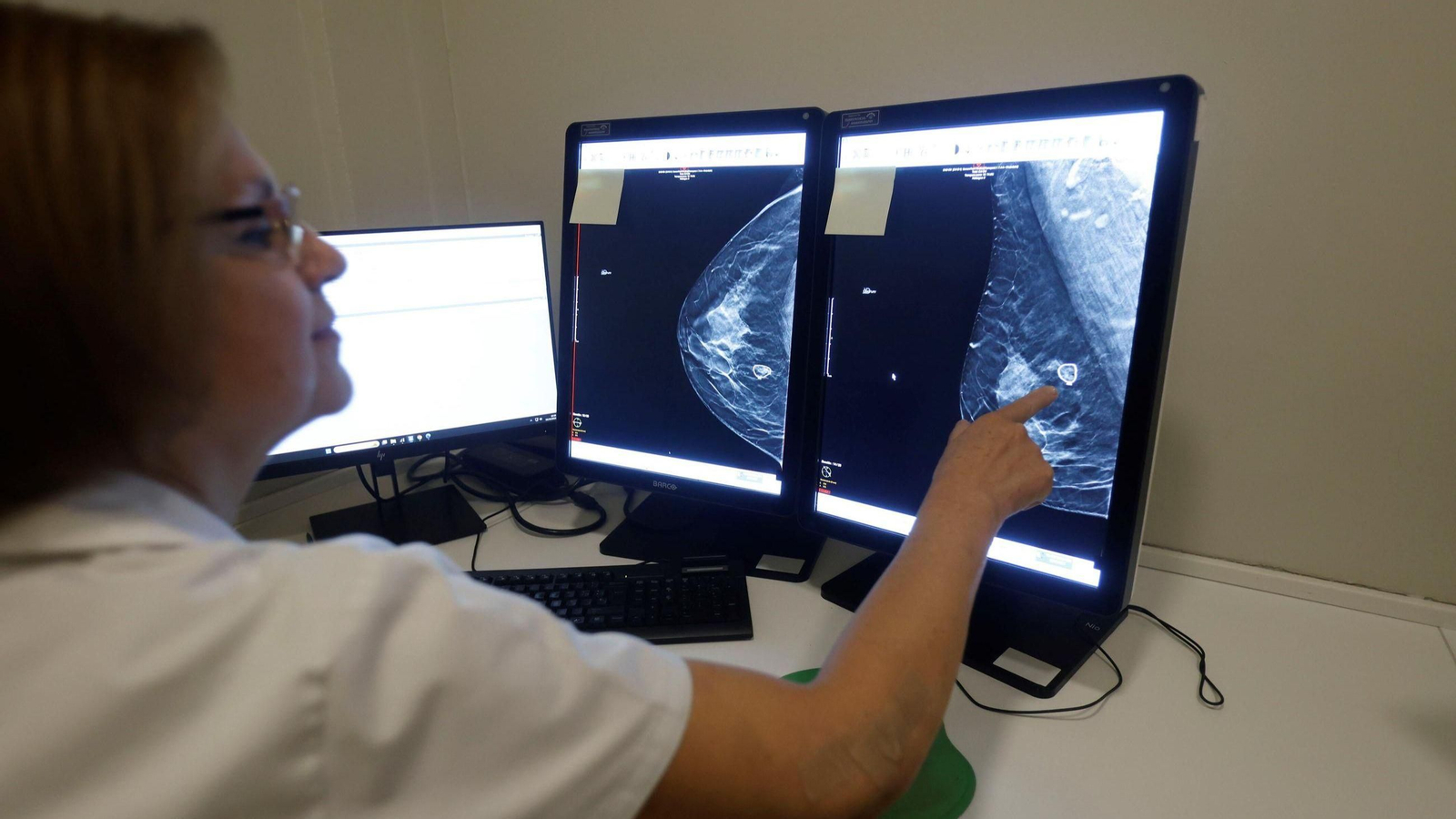 Una mamografía de cribado de cáncer de mama | Imagen de archivo