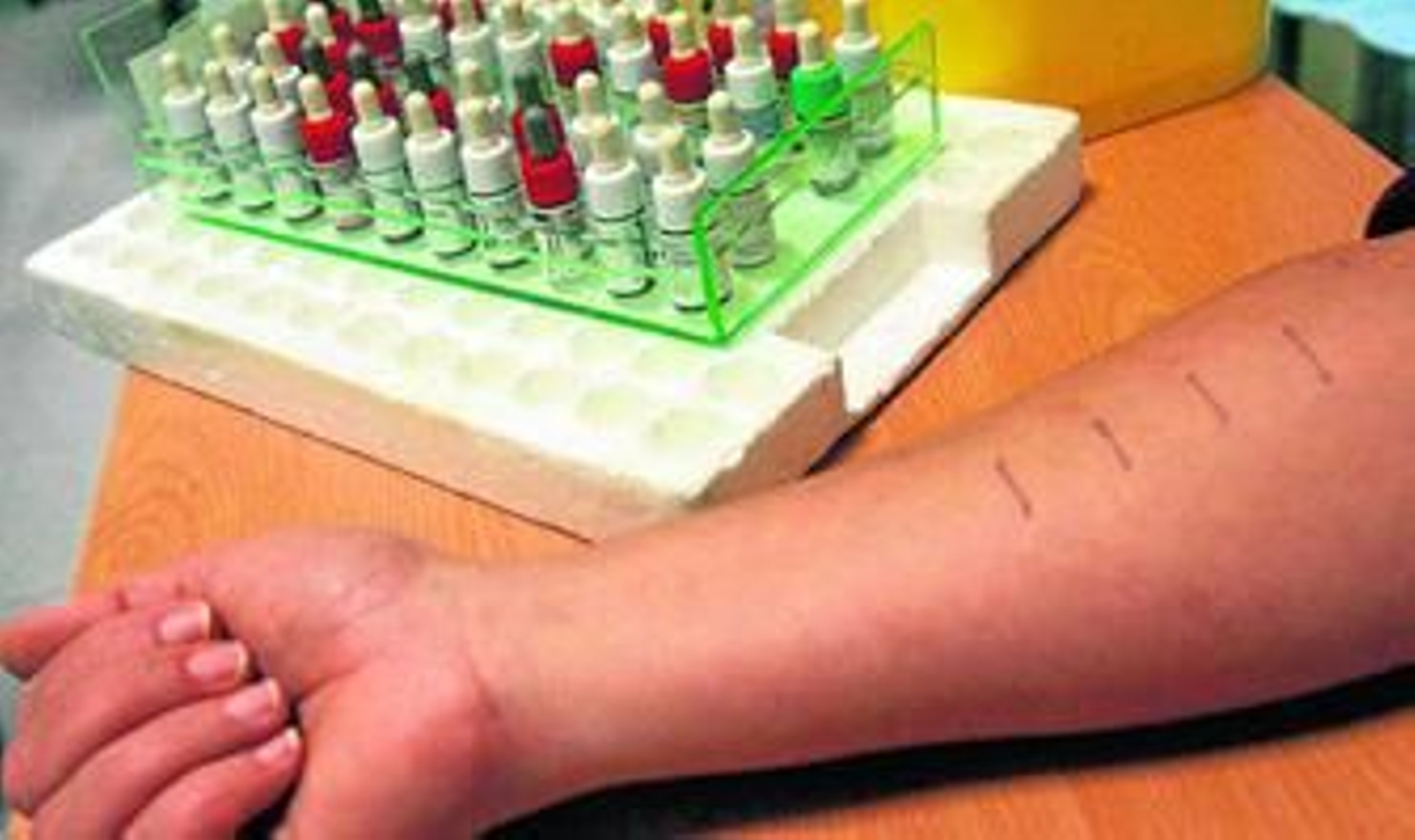 La prueba de alergia es la única forma de confirmar la reacción a pólenes, insectos o alimentos.