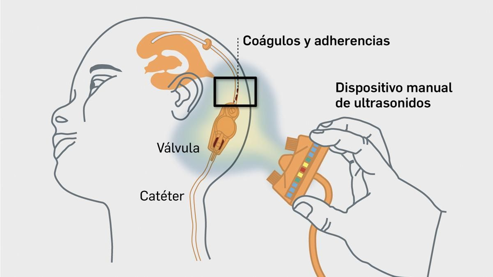 FusClean: Un proyecto pionero frente a complicaciones de la hidrocefalia