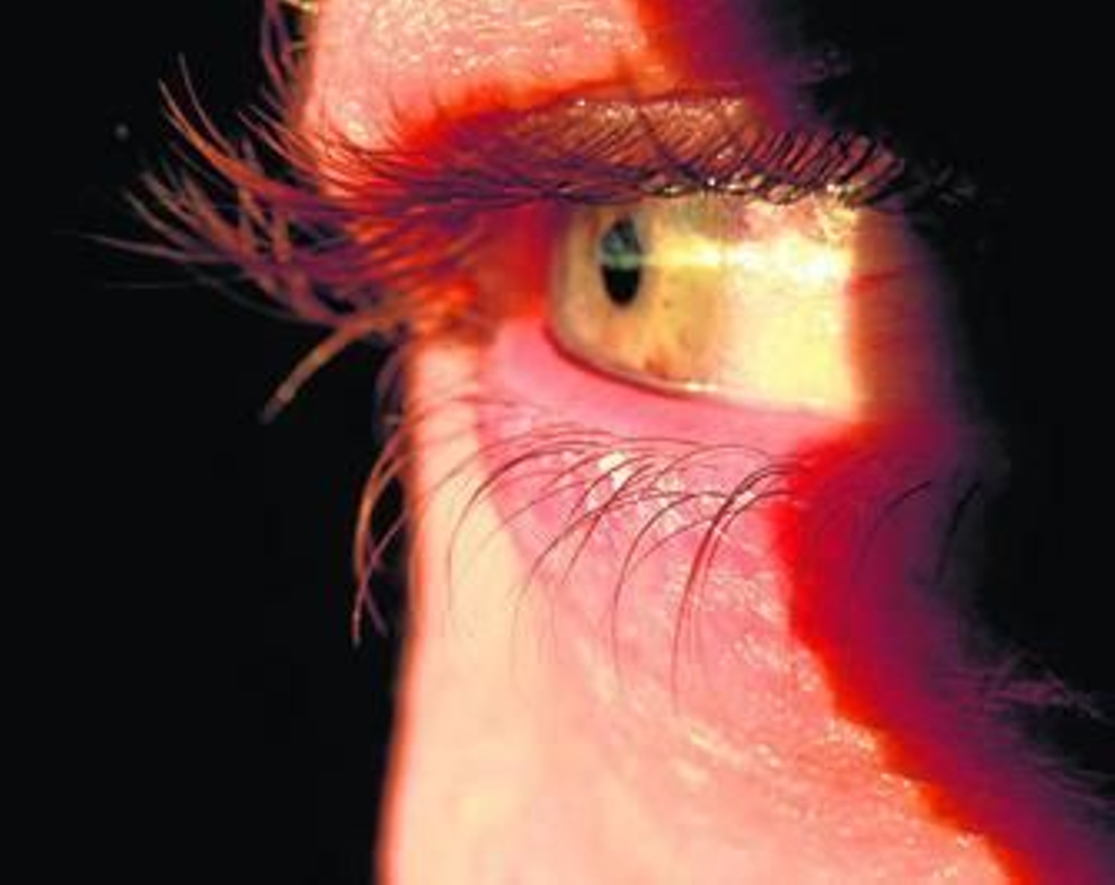 Imagen de un ojo humano afectado por una prolongada exposición al sol sin protección.