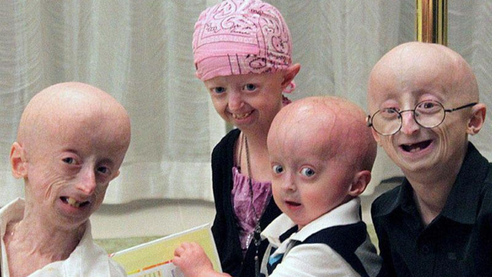 progeria