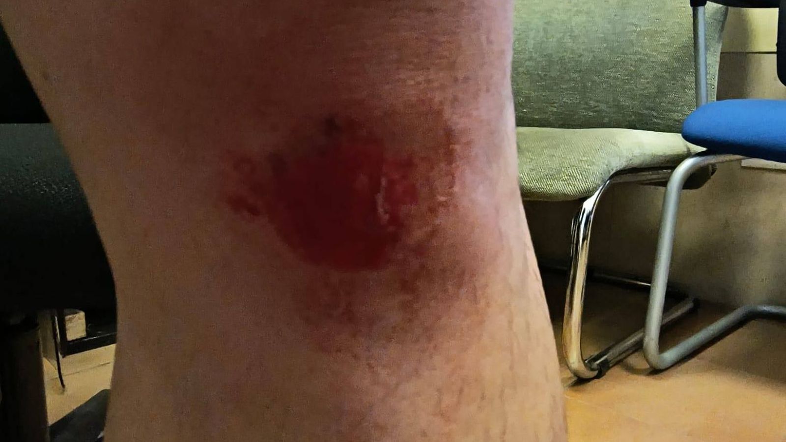 Herida en una pierna en uno de los agentes.