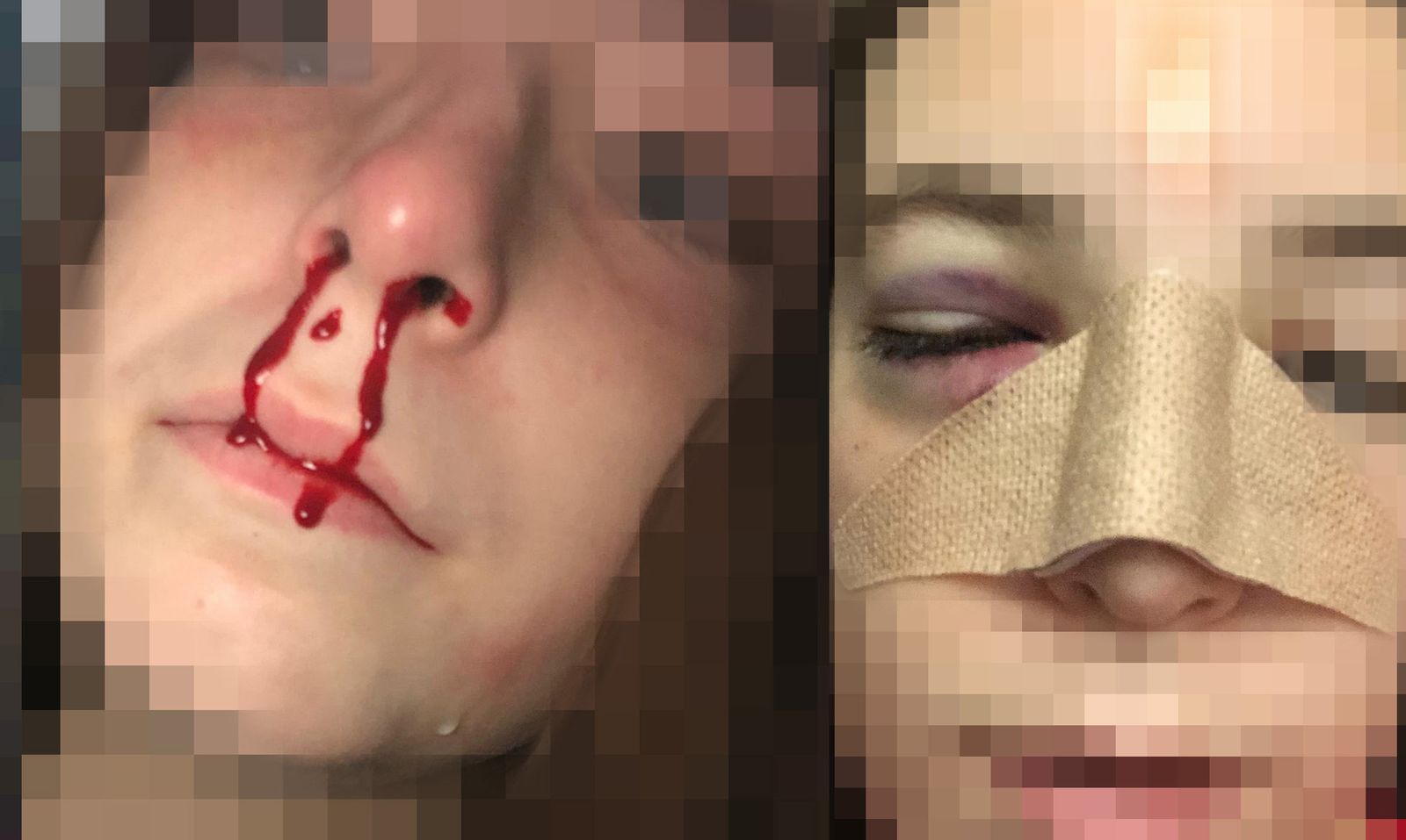 La niña agredida, tras el puñetazo y tras ser atendida.