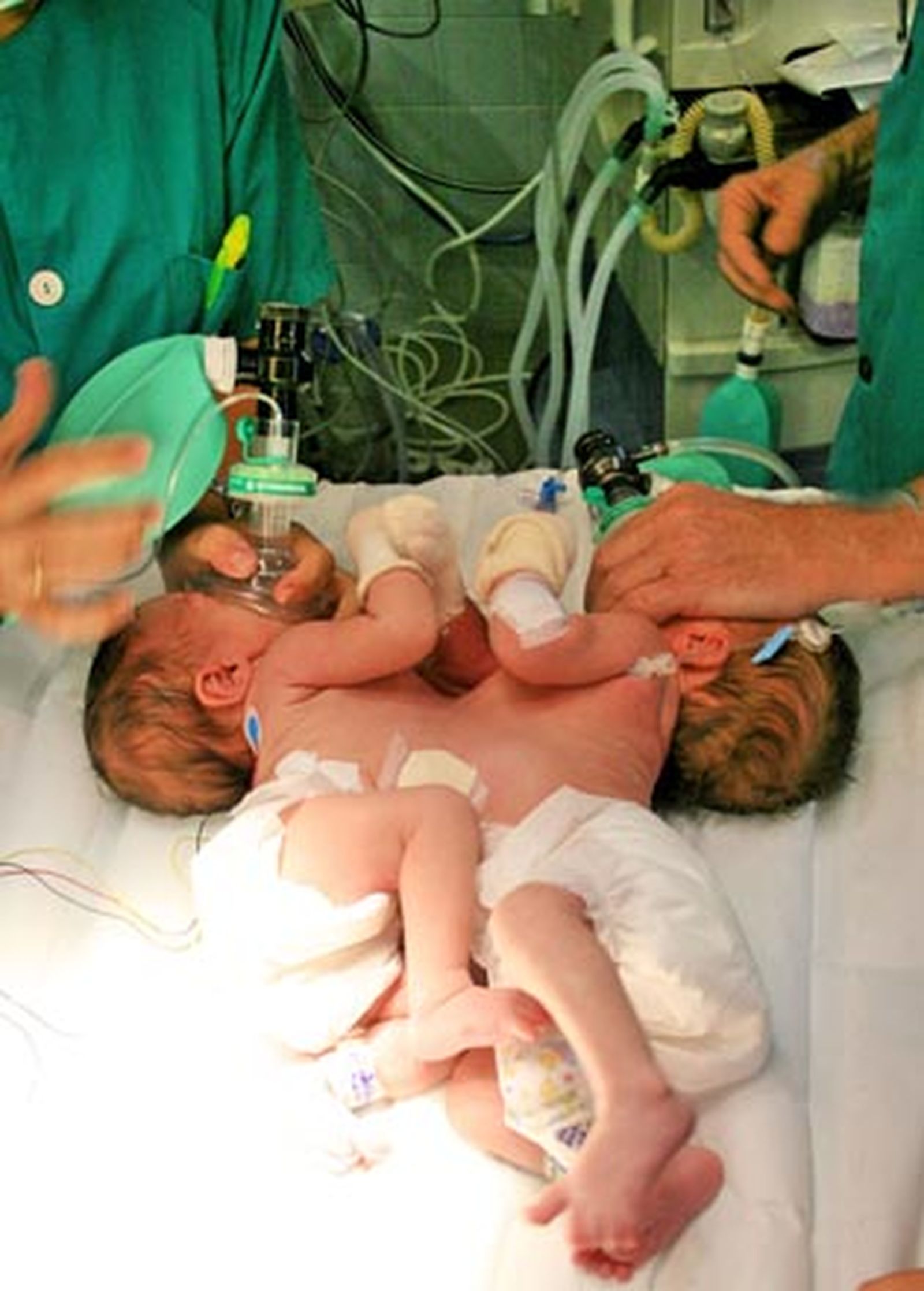 Separan a dos siamesas unidas por el abdomen en el Virgen del Rocío