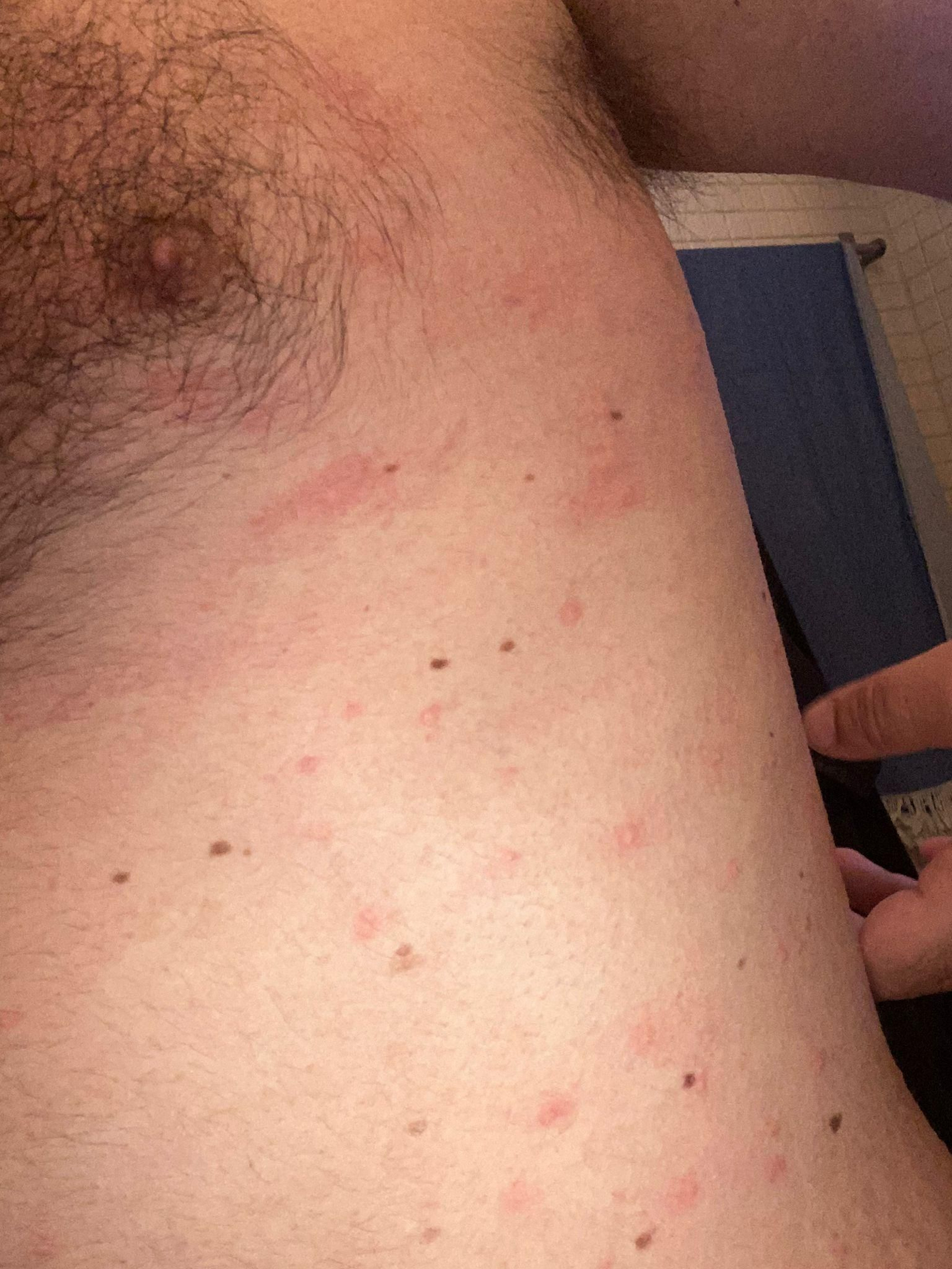 Un asistente al festival muestra sus picaduras.