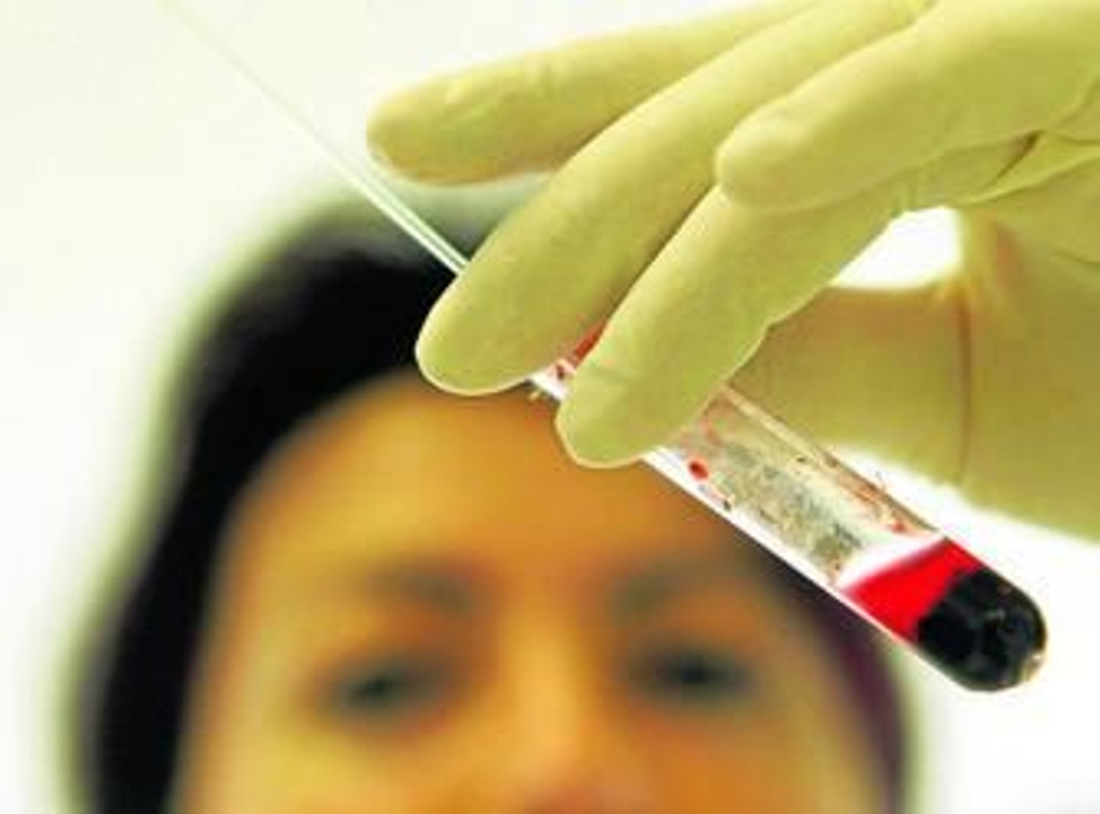 Un análisis de sangre  ayuda a confirmar la presencia de la enfermedad.