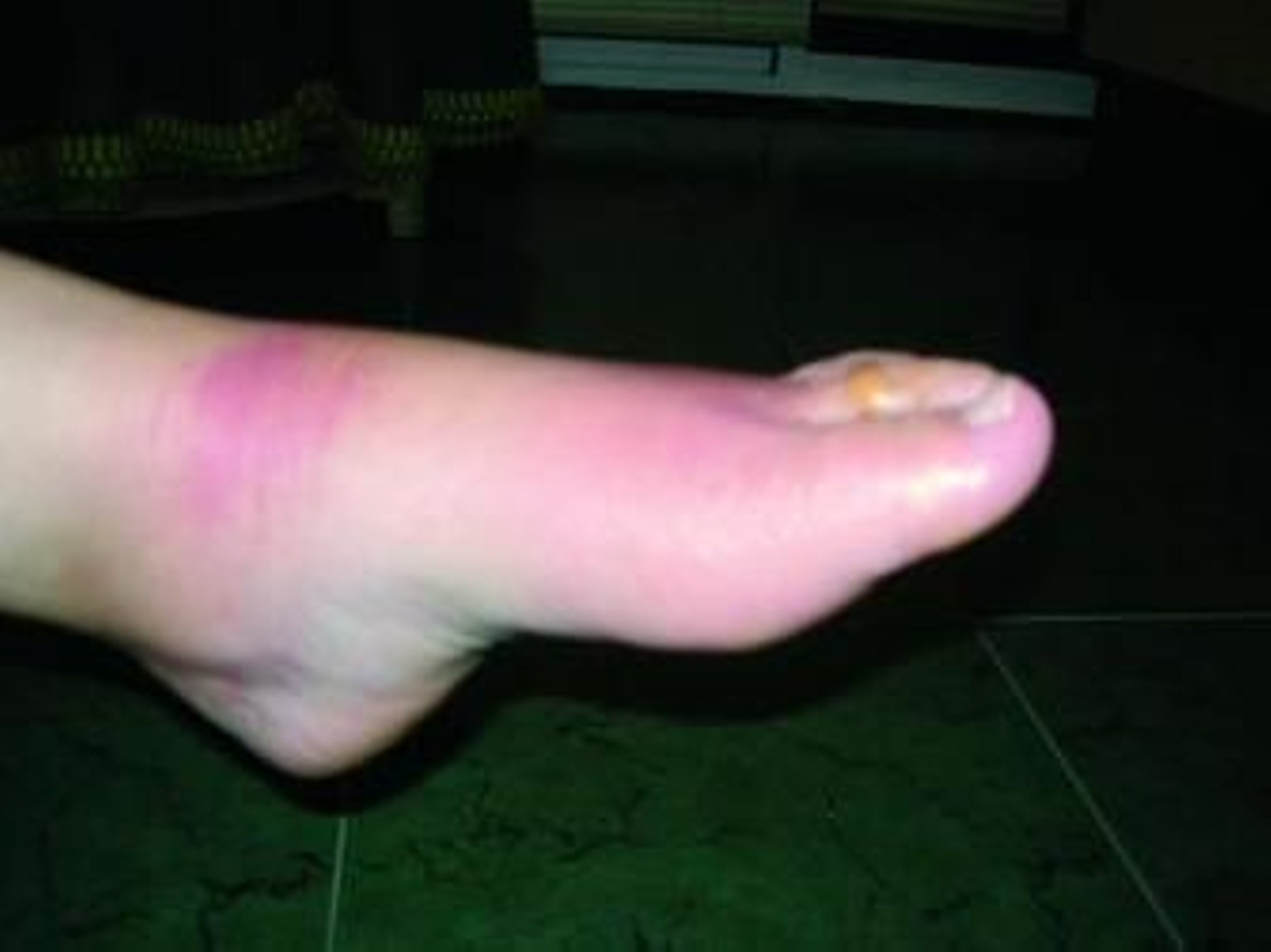 Consecuencias de la alergia de la toxicidad en los zapatos.