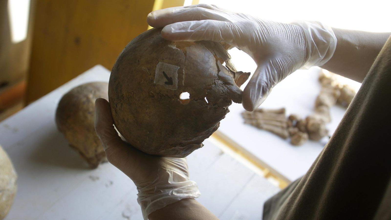 Orificio de bala en uno de los cráneos exhumados que demuestran la muerte violenta.
