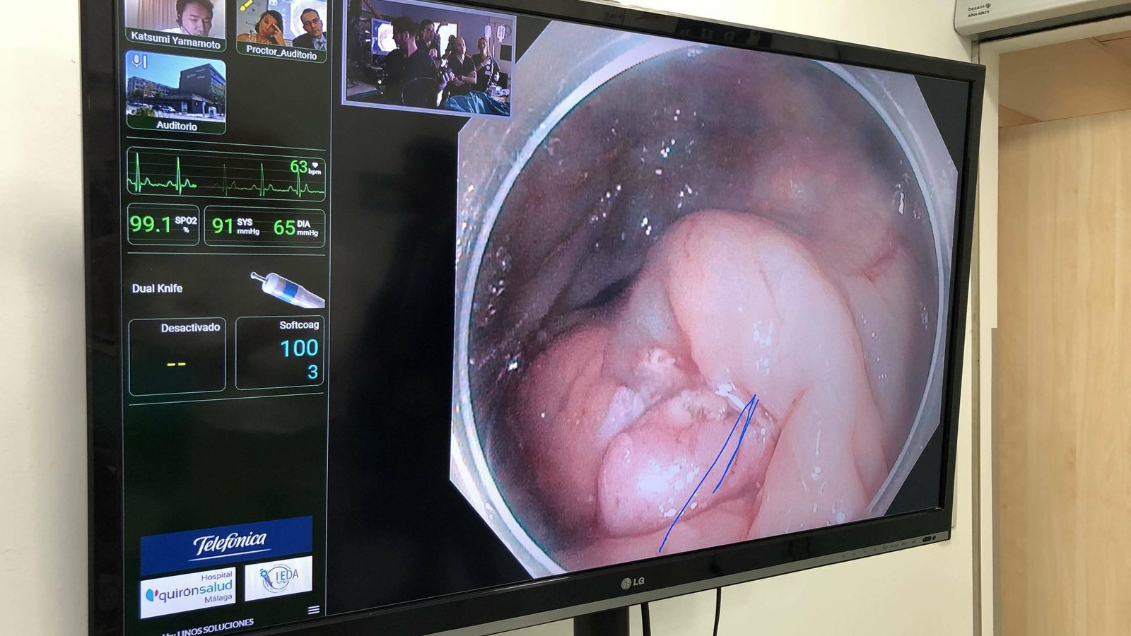 La pantalla en la que se aprecia el interior del colon y el doctor Yamamoto, en la parte superior izquierda