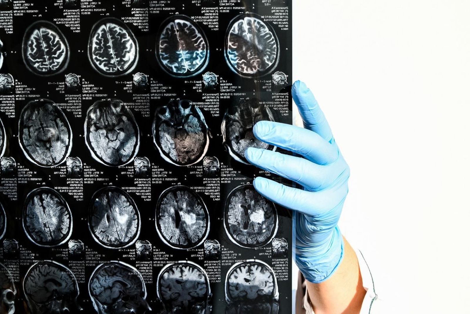 Un médico revisa una prueba cerebral.