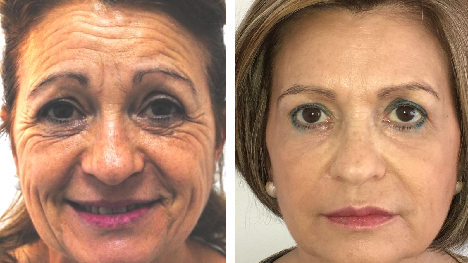 Rejuvenecimiento global del rostro con técnica 4x9 sin cirugía Dr. Kosmecki .