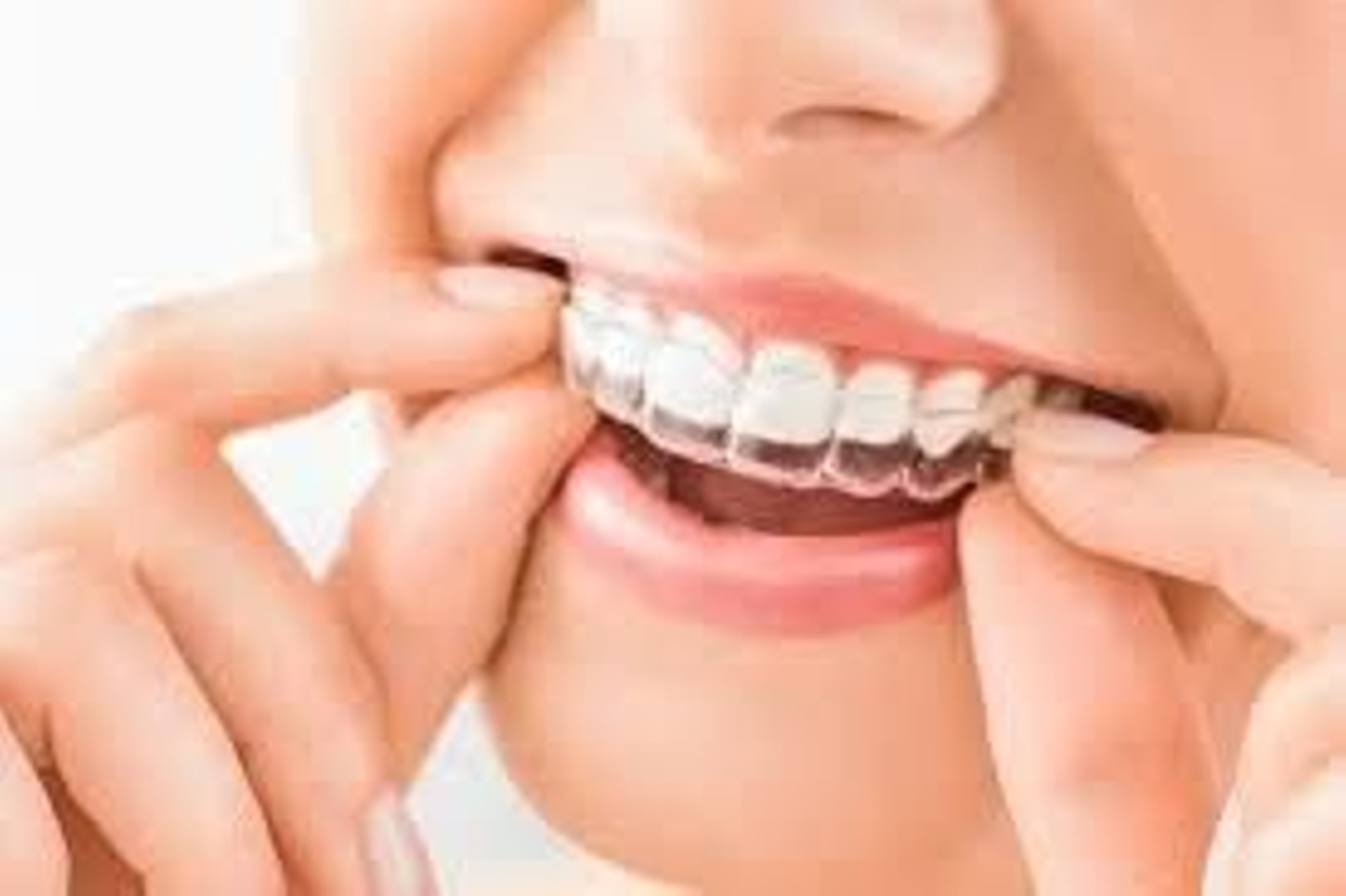Alineador dental.