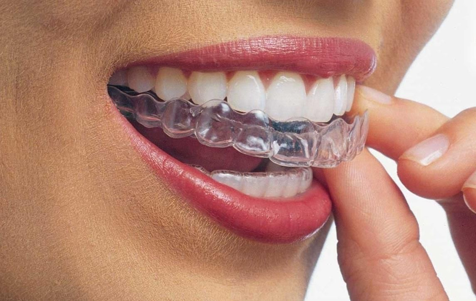 Alineador transparente.