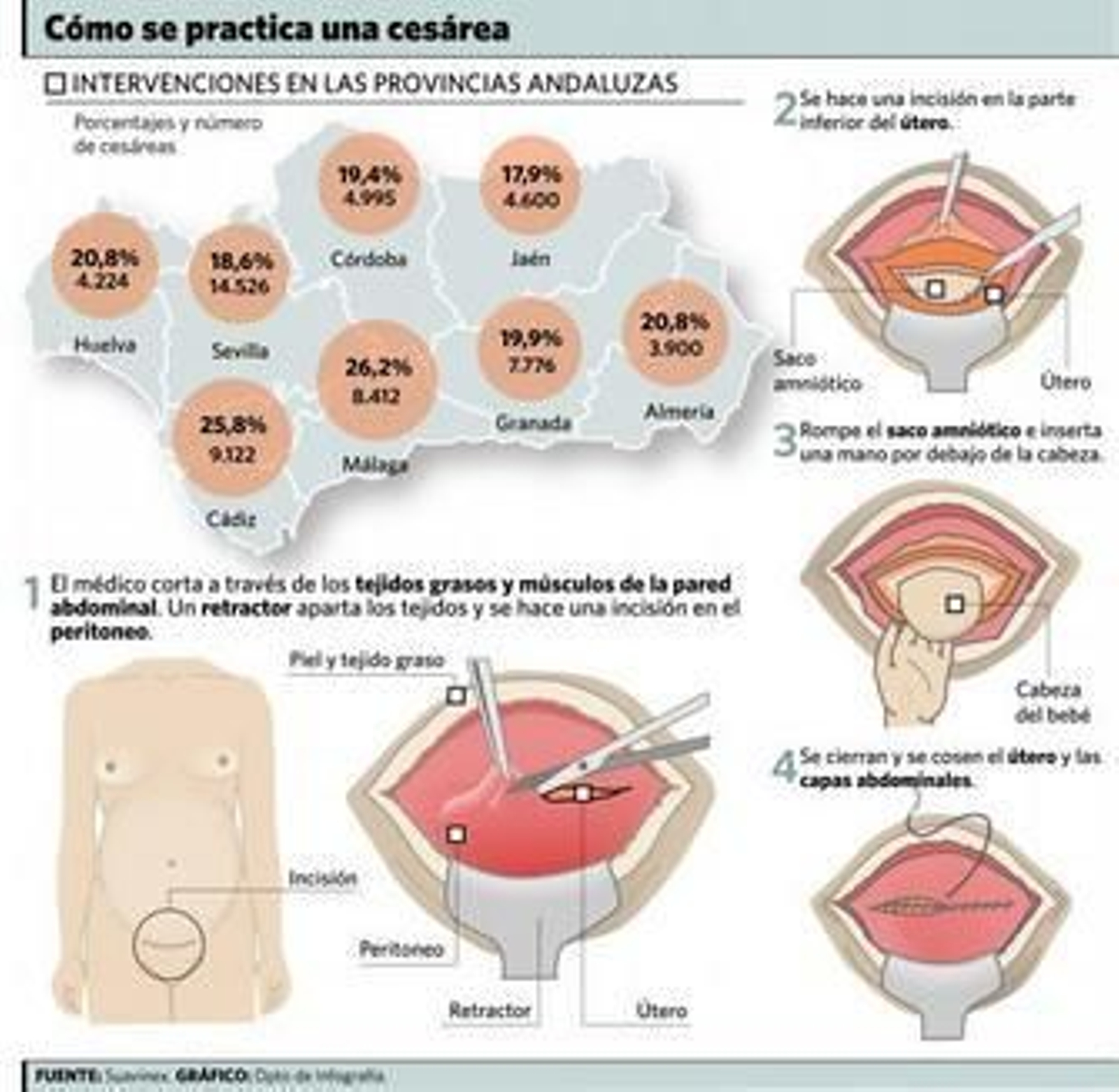 La sanidad privada realiza el doble de cesáreas que el SAS