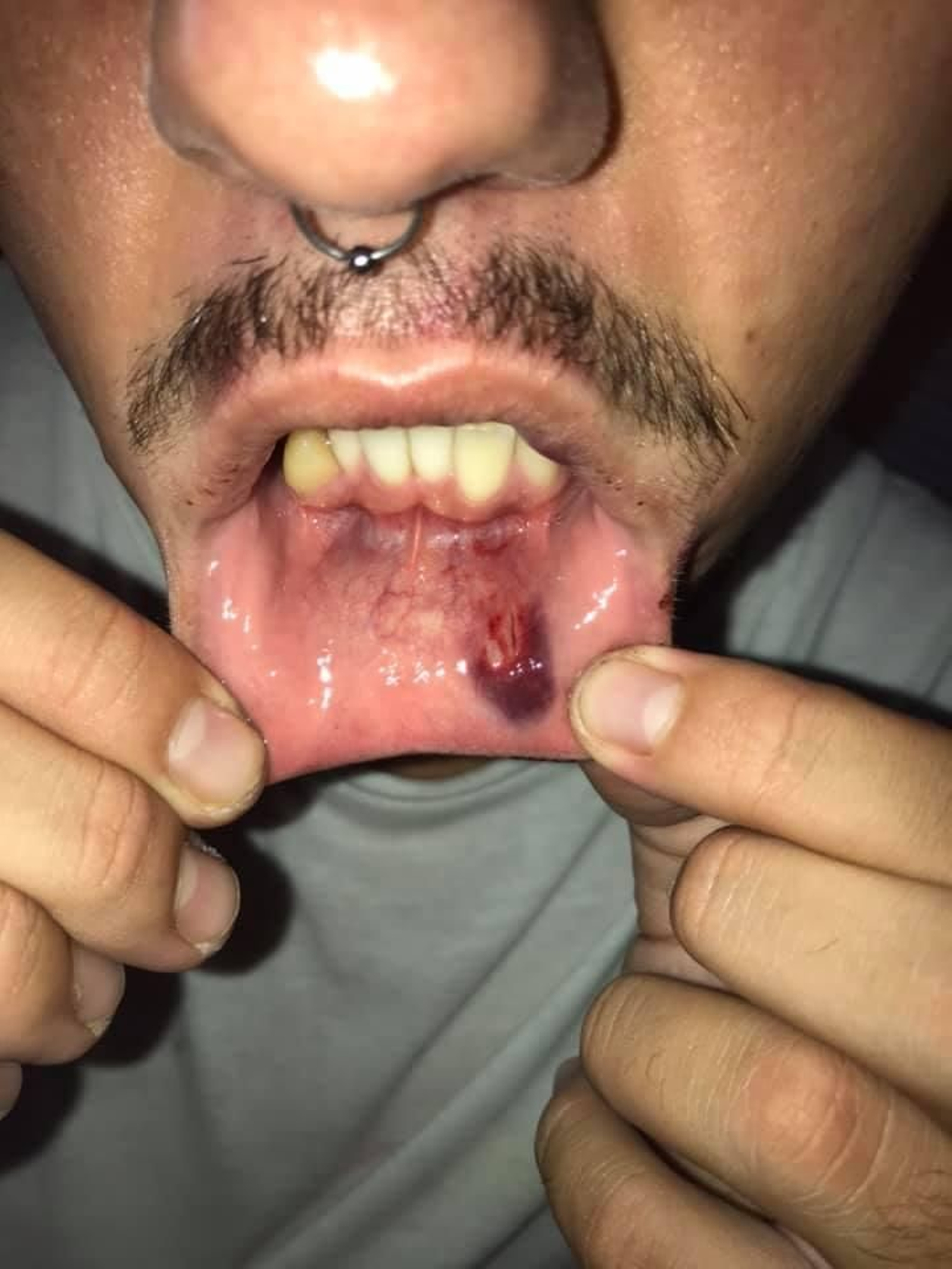 Foto subida por el joven a su perfil de Facebook en el que se aprecían las heridas sufridas.