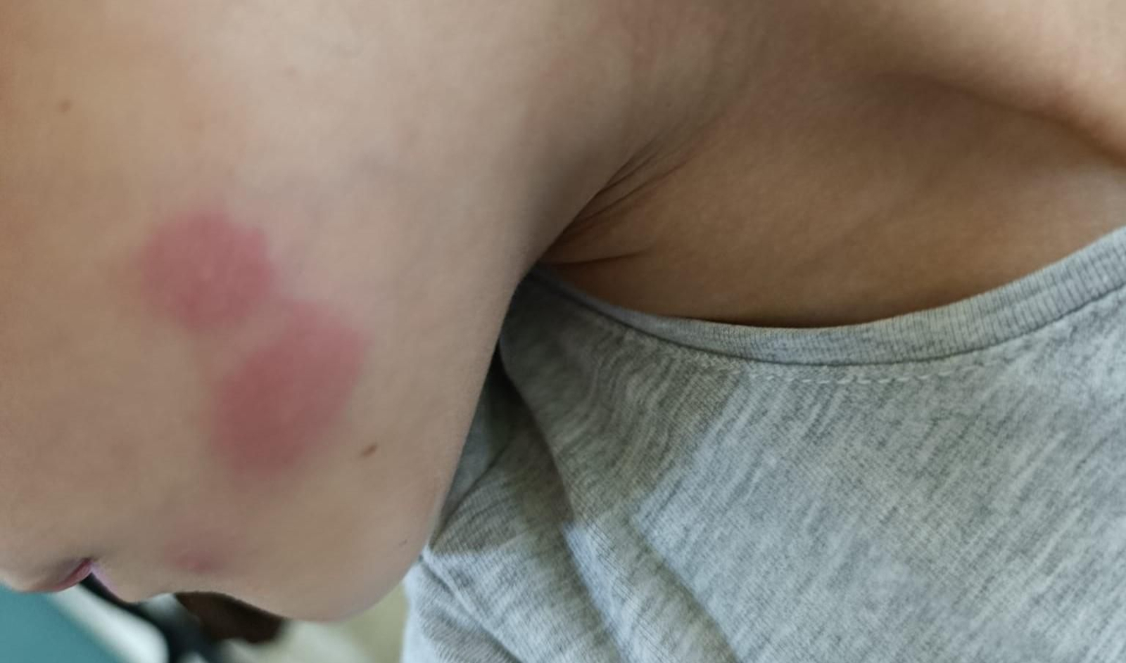 Picadura de un insecto a una alumna del CEIP Jacarandá.