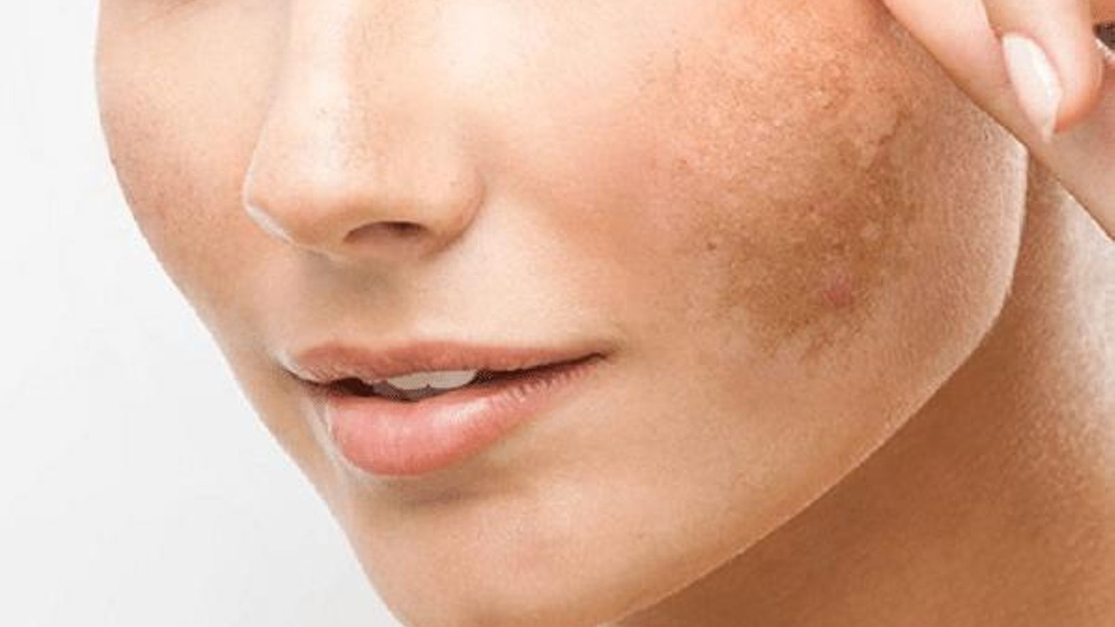 Algunas de las manchas que aparecen en la cara se deben a causas hormonales. Algunas de las manchas que aparecen en la cara se deben a causas hormonales.