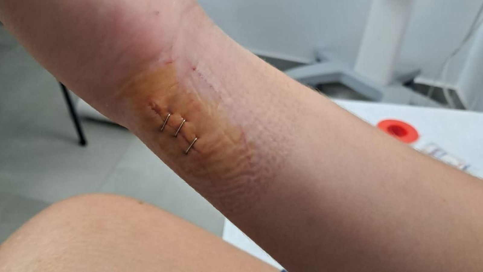 El menor tuvo que ser atendido en el Hospital recientemente, tras romper con el brazo un cristal en el campamento.
