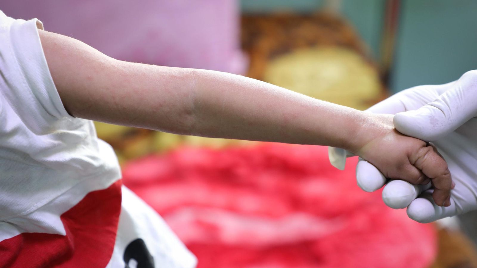 Una niña con sarampión.