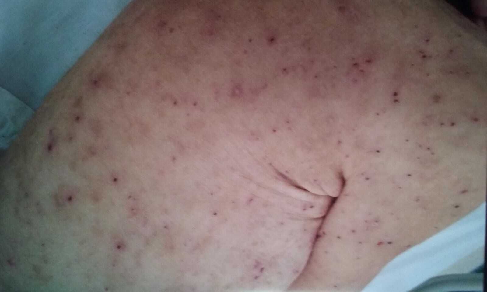 Una persona afectada.