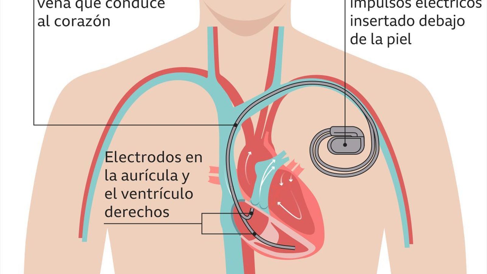 _118970419_heart_device_v2_spanish_640-nc