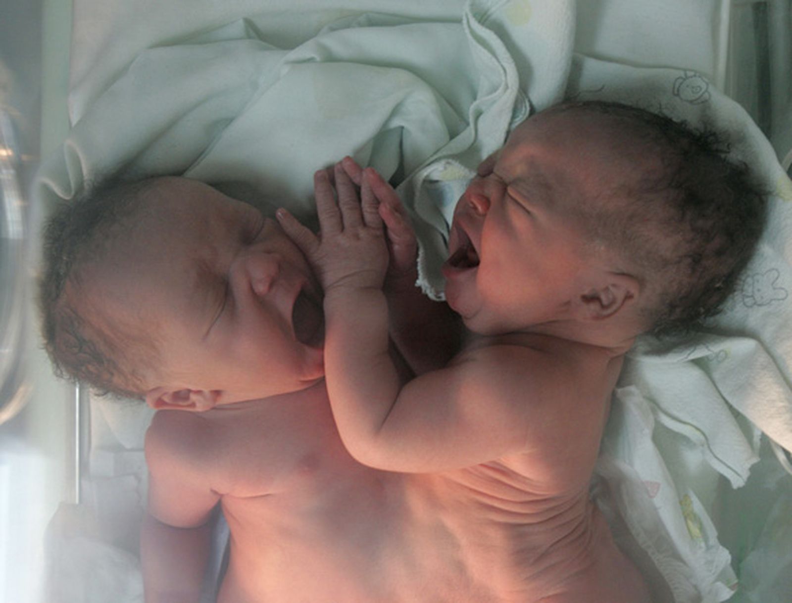 Nacen unas siamesas unidas por el abdomen en la República Dominicana